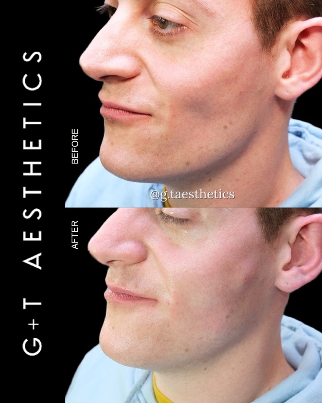 Cheek enhancement is about more than adding volume - it's about restoring facial balance and creating natural-looking definition.
This transformation demonstrates how subtle enhancements can refresh the overall appearance while maintaining facial harmony.
📲Enquire or visit www.gtaesthetics.co.uk for more info.
#CheekFiller #DermalFillers #BeforeAndAfter #FacialContour #NaturalAesthetics #GTAesthetics