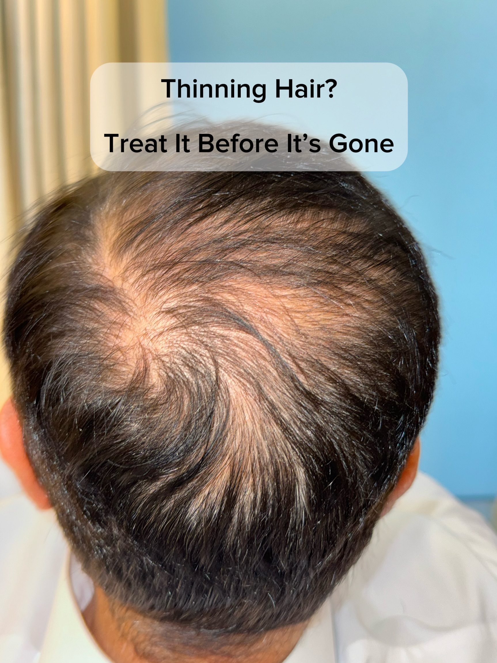 Six months ago, we started this patient’s treatment for crown thinning.
🔺Hair color changed during treatment (patient stopped coloring his hair).
His treatment plan was completed over approximately two months, with regenerative treatment as the foundation. These photos were taken four months after his final session.
One of the biggest misconceptions about hair loss is waiting until the thinning becomes obvious.
Hair doesn’t disappear overnight.
It gradually becomes thinner, weaker, and less dense. At this stage, many follicles are still alive and can often respond well to the right treatment.
But if hair loss continues without treatment, some follicles eventually become non-viable. At that point, regenerative treatments can no longer restore those areas, and different treatment options may be needed.
The goal of regenerative medicine isn’t simply to “grow more hair.”
It’s to preserve and strengthen the hair you still have—before it’s too late.
The earlier the diagnosis, the better the opportunity to preserve your hair.
.
.
.
#regenerativetreatment #hairloss #hairtransplant #hairrestoration