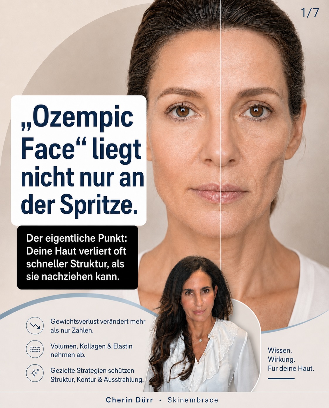 Du nimmst ab – aber dein Gesicht zieht nicht einfach mit?
Genau das sehen wir aktuell immer häufiger in der Praxis.
Ob durch GLP-1, Mounjaro, Ozempic, Ernährungsumstellung, Stress oder hormonelle Veränderungen: Wenn Gewicht verloren geht, verändert sich oft nicht nur der Körper – sondern auch das Gesicht.
Wangen wirken schmaler.
Konturen werden weicher.
Die Haut wirkt müder.
Und plötzlich fühlt sich das eigene Spiegelbild nicht mehr ganz stimmig an.
Gerade bei Frauen in der Perimenopause oder Menopause kommt noch ein wichtiger Punkt dazu:
Die Haut verändert sich hormonell. Kollagen nimmt ab, Elastizität wird weniger, die Haut wird oft trockener, dünner und weniger belastbar.
Deshalb ist dieses Thema bei Skinembrace nicht einfach „Filler gegen Volumenverlust“.
Es ist Teil unseres ärztlichen Behandlungsportfolios für Frauen in Veränderungsphasen.
Wir begleiten dich ganzheitlich und individuell – mit Blick auf:
✨ Gewichtsveränderung
✨ Hautqualität
✨ Kollagenaufbau
✨ Volumenverlust
✨ Kontur & natürliche Frische
✨ Perimenopause / Menopause
✨ Longevity & Prävention
✨ Mikronährstoffe, Hormone und Stoffwechsel – je nach Situation
Unser Ziel ist nicht, dich zu verändern.
Sondern dich so zu begleiten, dass du dich in deiner Haut wieder wohlfühlst.
Natürlich. Ärztlich. Mit Plan.
Manchmal braucht es gezielten Volumenaufbau.
Manchmal Biostimulation mit Sculptra, Radiesse oder Polynukleotiden.
Manchmal Skinbooster, PRP, Morpheus8 oder eine Verbesserung der Hautbarriere.
Und manchmal beginnt der wichtigste Schritt mit einer genauen Analyse: Was braucht deine Haut wirklich – und was nicht?
Denn gerade in den Wechseljahren oder während einer Abnahmephase gilt:
Nicht möglichst viel machen.
Sondern das Richtige zur richtigen Zeit.
Wenn du merkst, dass sich dein Gesicht durch Gewichtsverlust, Hormone oder die Wechseljahre verändert, begleiten wir dich gerne ärztlich auf diesem Weg.
Speichere dir den Beitrag, wenn du gerade abnimmst oder dich in den Wechseljahren wieder mehr mit deiner Haut beschäftigen möchtest.
#skinembrace #wechseljahre #perimenopause #menopausehaut #gewichtsverlust glp1