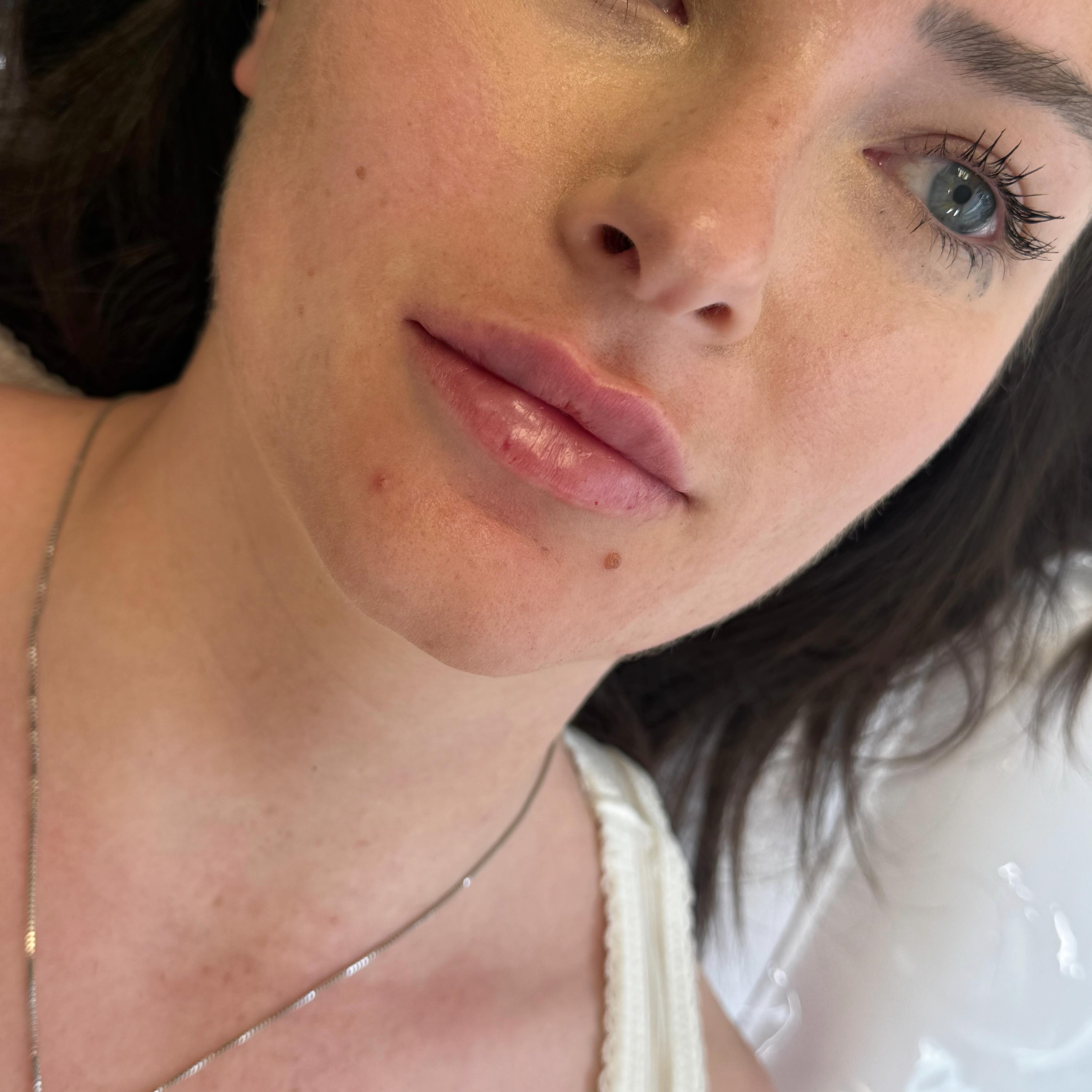 A natural lip enhancement after just one session of dissolving 🤍
Sometimes, the best results come from taking a step back before moving forward. We first dissolved the old, migrated and uneven filler to create a clean foundation, then carefully restored volume for a softer, more balanced result.
✨ Swipe to see the before we dissolved the previous filler and the transformation after.
If your lips have started to look overfilled, uneven or the filler has migrated, dissolving and starting fresh can often give the most beautiful, natural outcome.
Book online at www.bgaesthetics.co.uk 🤍
Pay in 3 with Klarna 🌸
#LipFiller #NaturalLips #LipDissolving #AestheticsClinic #LipTransformation