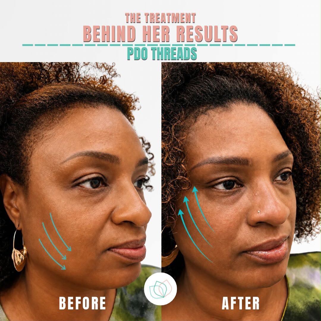 Say goodbye to sagging skin and hello to an instant, natural lift!
This incredible side-profile transformation shows the immediate power of a professional PDO Thread treatment.
Ready to unlock your own radiant results? Tap the link in our bio to book your consultation with our expert team today!
📍4600 West Village Place 3005, Smyrna, Georgia
#atlskincare #atlantabeauty #pdothreadsatl #atlantafacials #selfcareatl