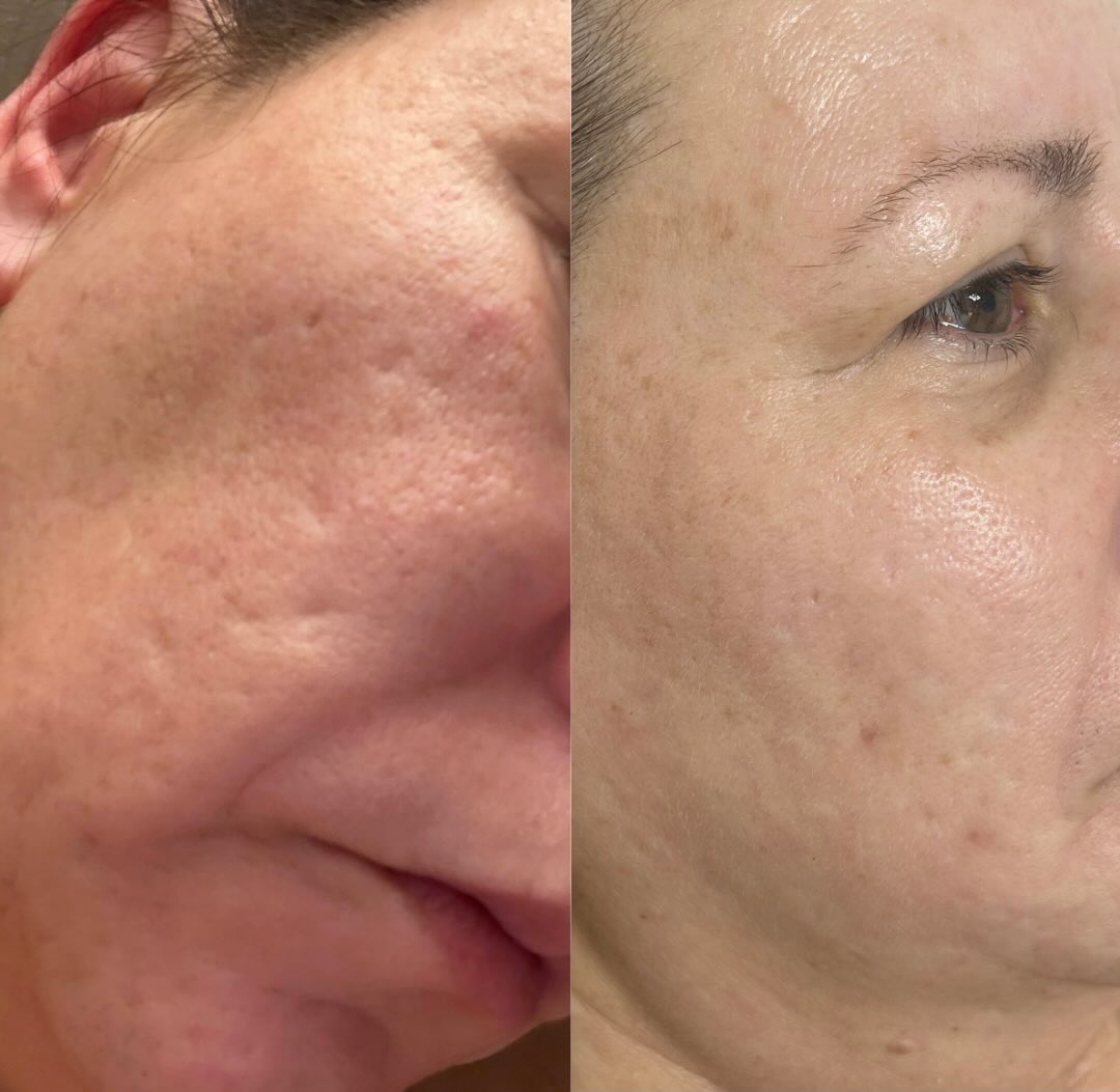 Acne scars don’t have to be permanent.
These before & after photos are after just ONE SkinPen® treatment paired with a customized medical-grade skincare regimen.
Acne scarring is a journey—not a one-time fix—but seeing this much improvement after a single session is exactly why I love combining in-office treatments with the right at-home products.
✨ SkinPen works by stimulating your body’s natural collagen production to gradually smooth acne scars and improve skin texture.
✨ Medical-grade skincare supports healing, enhances your results, and helps maintain your investment.
Every treatment plan at Villa Aesthetics is customized because no two scars—or patients—are the same.
If acne scarring has affected your confidence, let’s create a plan that works for your skin.
📍Villa Aesthetics
📅 Book your consultation today—your best skin starts with the first session.