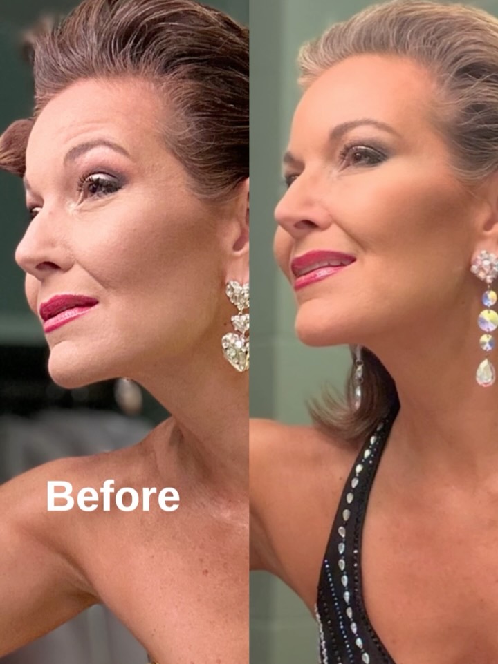 I wanted to share this before and after picture since so many people have reached about my skincare journey. Since I’m in the exact same dressing room right now at Miss NC as I was three years ago…aka, same lighting and nearly the same pose…I wanted you to see the before and after. This is three years of new skincare strategy and focus. After years of putting it off because “it’s too self centered” or “I’ll work on that later”…it was just time! There are no filters on these photos. It’s a night and day difference on the quality of my skin and texture. I’m also eating healthier and leaning in on not trying to be a size 0 anymore. I’m almost 52, have two beautiful daughters that my body produced and have had all the transitions at this age. The after photo is a healthier more radiant version of me, as Heather…even with the longer hair and I am loving all of it:).
Here is one of the products I was introduced to by @theskingroup that I absolutely love! It’s an essential of my morning routine to help even out my complexion.
ZO Skinhealth
10% Vitamin C Self-Activating
10% vitamin C that brightens skin, promoting a more even skin tone and minimizing the appearance of fine lines and wrinkles.
Benefits
➡️Helps minimize the appearance of surface discoloration
➡️Powerful antioxidants help defend against environmental triggers
➡️Helps minimize the appearance of fine lines and wrinkles.
#theskingroup #zoskinhealth #vitaminc #skincare #menopause