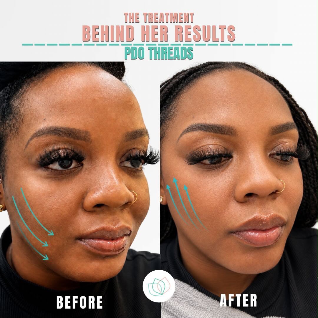 The treatment behind her results.
Check out this incredible before and after transformation showing the power of our specialized PDO thread treatment. at Pretty Faces Atlanta, we focus on subtle, structure-enhancing tweaks that define your natural beauty, smooth out fine lines, and leave you with a refreshed, youthful lift. real, beautiful results happen when expert care meets clinical precision.
Ready to elevate your skin and profile? Tap the link in our bio or send us a DM to book your botox & pdo consultation today! 🩺
📍4600 West Village Place 3005, Smyrna, Georgia
#atlantamedspa #atlbotox #pdothreadsatl #atlbeauty #beforeandafteratl