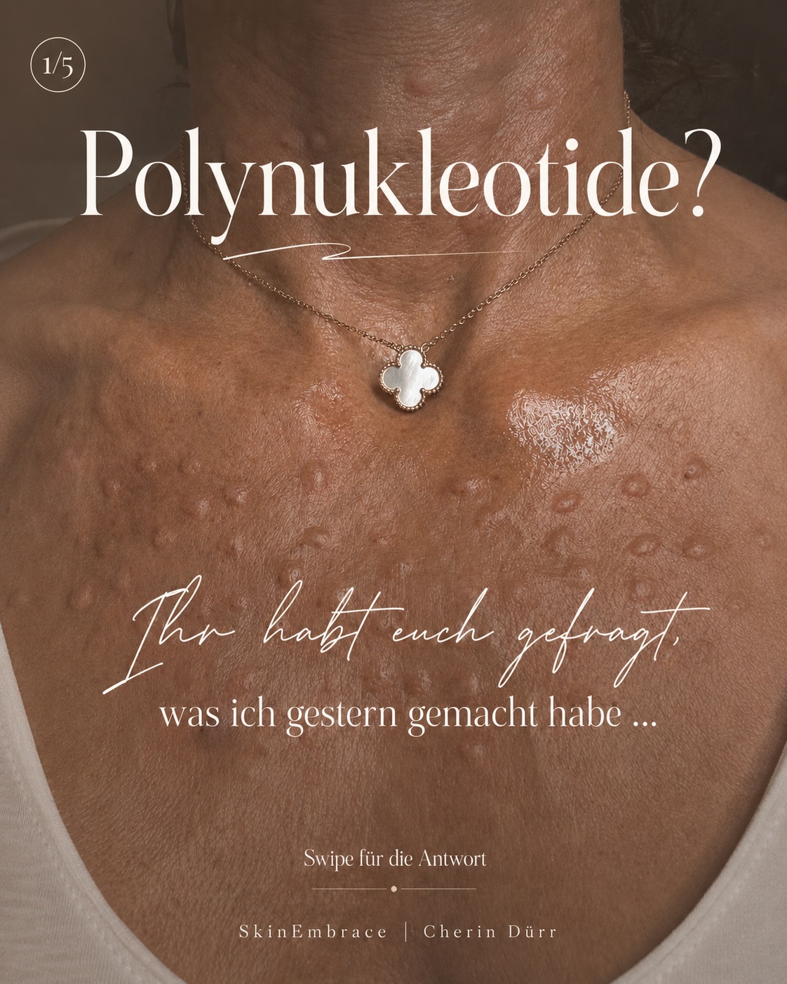 Ihr habt euch gefragt, was ich gestern behandelt habe…
Die Antwort: Polynukleotide.
Eine meiner liebsten Behandlungen, wenn es nicht um „mehr Volumen“ geht, sondern um bessere Hautqualität, Regeneration und diesen frischen, erholten Look.
Polynukleotide unterstützen die Haut dabei, sich von innen heraus zu regenerieren. Sie können Feuchtigkeit, Elastizität und Struktur verbessern – besonders schön, wenn die Haut müde, trocken, dünner oder etwas „knittrig“ wirkt.
Ich setze sie gerne ein bei:
Augenpartie, Gesicht, Hals, Dekolleté und auch bei kleinen Narben oder empfindlicher Hautstruktur.
Und das Beste: Die Behandlung ist nicht nur dann spannend, wenn schon etwas „stört“. Sie eignet sich auch wunderbar präventiv – also als Skin-Quality-Treatment, bevor die Haut sichtbar an Spannkraft verliert.
Natürlich ist nicht jede Behandlung für jede Haut gleich sinnvoll. Deshalb schaue ich mir immer zuerst an: Was braucht deine Haut wirklich? Feuchtigkeit? Regeneration? Struktur? Kollagenstimulation? Oder eine Kombination?
Mein Ziel: frisch, natürlich, gesund aussehend – nicht gemacht.
Wenn du wissen möchtest, ob Polynukleotide zu deiner Haut passen, schreib mir gerne eine Nachricht oder vereinbare einen Beratungstermin.
#polynukleotide #skinquality #skinbooster #regenerativemedicine #aestheticmedicine
