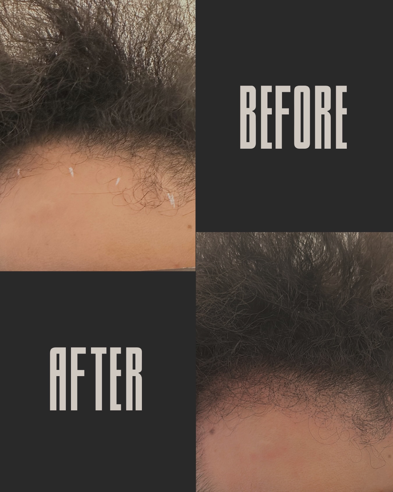 Viele Menschen denken bei Haarausfall sofort an komplett kahle Stellen. Dabei beginnt es oft viel früher.
Entweder wird die Haarlinie lichter, die Kopfhaut schimmert stärker durch oder das Styling funktioniert plötzlich nicht mehr wie früher.
Genau hier kann eine Haarpigmentierung ansetzen, um optisch wieder mehr Dichte, Kontrast und eine definiertere Haarlinie zurückzugeben.
Auf dem Bild siehst du genau das.
Kein Filter.
Kein Haarteil.
Keine Haartransplantation.
Nur eine gezielte optische Verdichtung.
Wäre dir dieser Unterschied im Alltag aufgefallen? 👇
#haarausfall
#haarpigmentierung
#scalpmicropigmentation
#potsdam