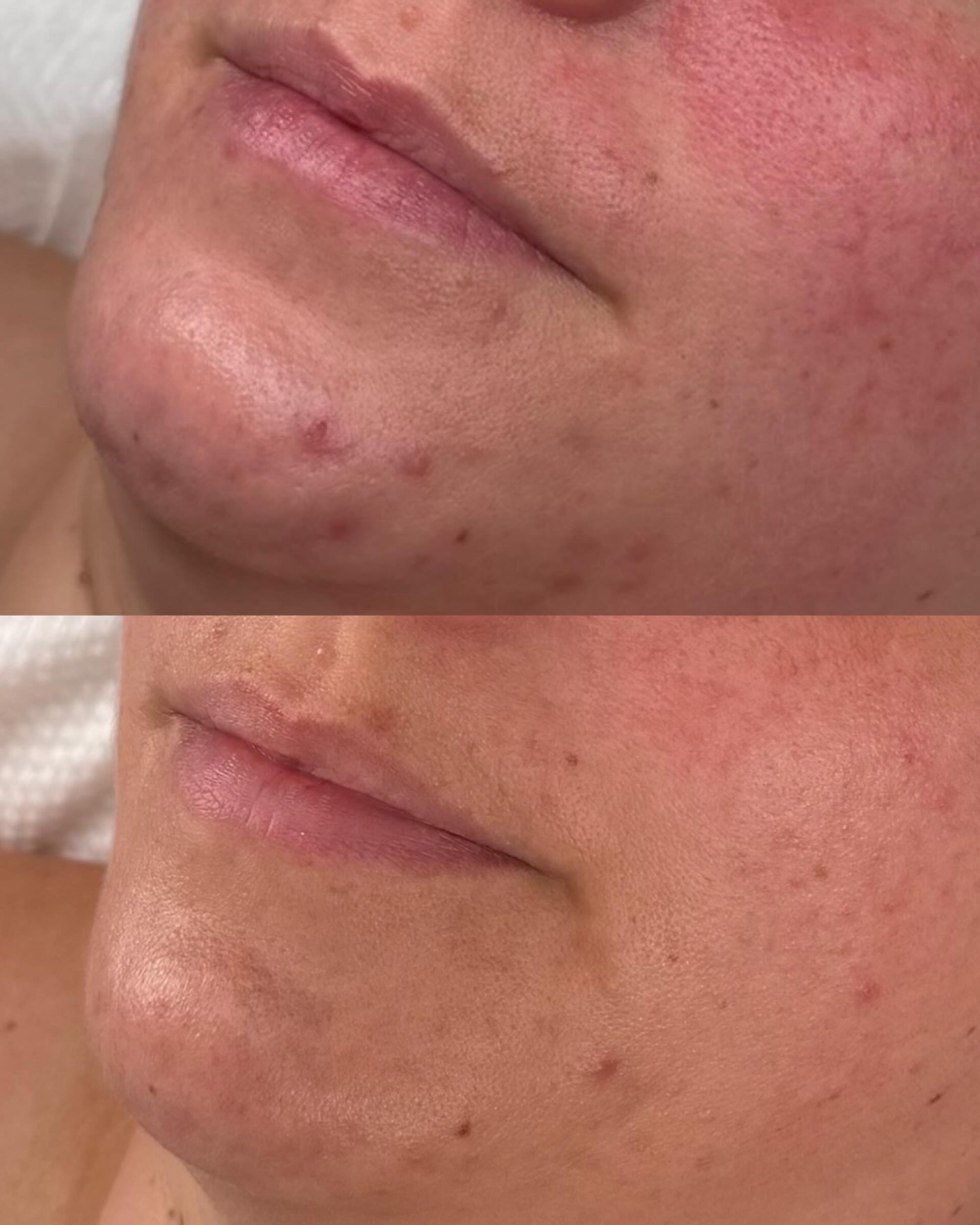 In 3 months we’ve gone from inflamed and angry, to clear and calm 🧘🏼♀️🤍
This is what three months of actually listening to your skin looks like! 👂🏼
Not three months of stripping it back with acids 🔥
Not three months of piling on actives and hoping for the best 🧴
Three months of understanding why it was angry in the first place - and then giving it exactly what it needed to heal 🤍
When skin looks like this = inflamed, reactive, breaking out in clusters, the instinct is to fight it. Dry it out. Exfoliate harder. Reach for the strongest thing on the shelf.
But that inflammation is a signal, not a flaw. It’s your skin telling you it’s under stress, its barrier is compromised, and it desperately needs support rather than a battle 😥
So that’s what we did. We worked on calming the nervous system, because chronic stress keeps your body in a state that quite literally feeds breakouts. We focused on deep, consistent hydration to rebuild a barrier that had been fighting to survive, and we built a routine around repair and calm rather than correction and control 🧘🏼♀️
The skin you can see in that bottom photo isn’t filtered or freshly treated. That’s just her skin now. Settled. Clear. Breathing.
If you’re looking at your own skin right now and recognising that inflammation, that frustration, that feeling of trying everything and getting nowhere - this is your sign that there’s a different way 🪧
I offer free 15-minute discovery calls to chat through where you’re at and how I can help you get results like this. No pressure, no obligation - just clarity.
DM the word “DISCOVERY” to book yours 📲 ✨