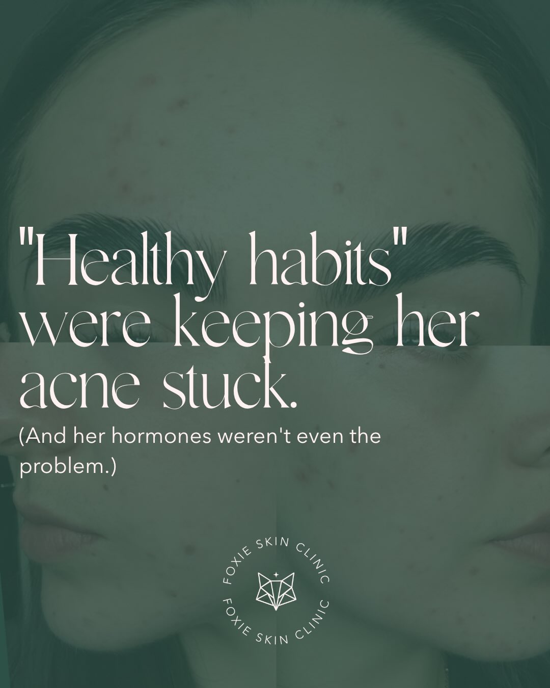 Three weeks. That’s all it took to start transforming her skin - and it was nothing to do with her hormones 👀
She came to me exhausted, broken out, and completely defeated 🫠
Her periods had stopped, her energy was gone, and her GP had told her everything looked normal.
She was training hard, eating clean, cutting out every food she’d ever been told was the problem. And nothing was working 😥
When we ran her blood work, the picture became clear very quickly🩸
It wasn’t her hormones causing the chaos. It was the fact that her body was so under-fuelled, so overstressed, and so depleted that it had gone into full survival mode, and you simply cannot clear your skin from that state.
So we stopped fighting her body and started supporting it instead.
🏋️♀️ Less high intensity training, more rest.
🥗 More food, but with proper nourishment.
🧴 A skincare routine that actually worked with her barrier.
🧘🏼♀️ And some real attention paid to her nervous system.
Three weeks later, her skin is calmer, her breakouts have reduced, and her confidence is already starting to come back. This is what’s possible when you stop guessing and start looking at the full picture 🫶🏼
If you’ve tried everything and your skin still won’t heal, it’s time to look deeper 🔍
DM me the word DISCOVERY and let’s book your free discovery call - because clear, confident skin starts with finding the real root cause.