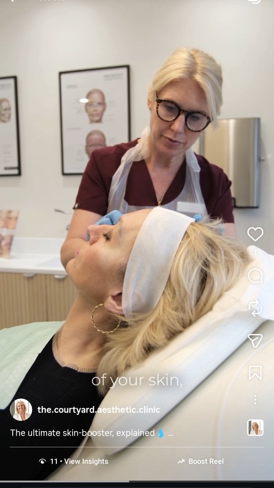The ultimate skin-booster, explained💧
Unlike traditional fillers, Profhilo doesn’t change your face shape, it acts like the ultimate injectable moisturiser, remodeling your skin from the inside out to boost collagen, elastin, and that healthy glow ✨
Who is it for?
👉 Anyone noticing the first signs of skin laxity
👉 If your skin is feeling dull, dehydrated, or losing its bounce
👉 Perfect for a natural, refreshed look (without the volume)
Have questions about Profhilo? Drop them in the comments below!
#profhilo #hydration #skininjectables #glow #skinclinic