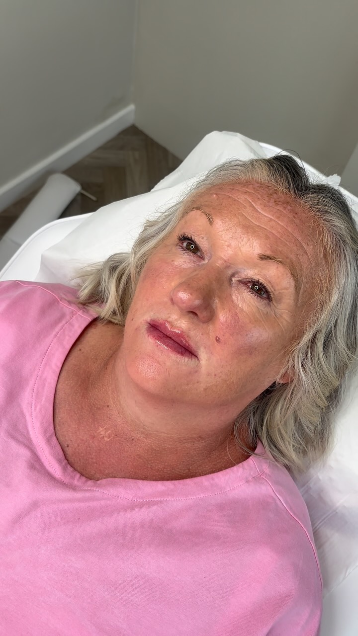 A subtle refresh can make all the difference.
This lip enhancement was designed to restore hydration, improve shape and create balanced, beautifully defined lips while maintaining a soft, natural finish.
Schedule your appointment on our website ๐ค
โโ
#dermalfiller #scunthorpeaesthetics #lincolnshireaesthetics #scunthorpebusiness #nurse
