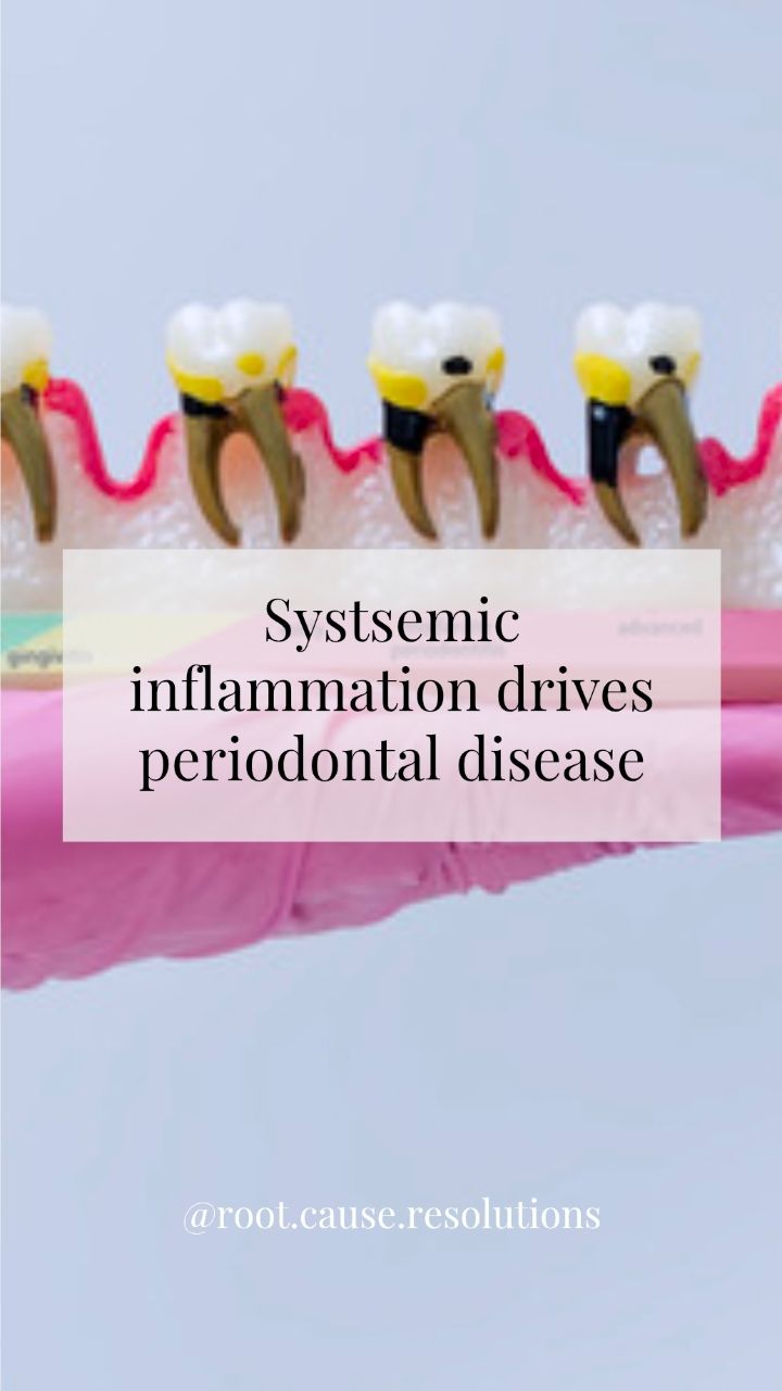 We often talk about plaque and bacteria, but periodontal disease isn't just a bacterial problem. It's an inflammatory disease.
When the body is experiencing chronic systemic inflammation, the immune system becomes dysregulated, increasing susceptibility to tissue breakdown, delayed healing, and persistent inflammation within the gums.
Drivers of systemic inflammation
➡️ Poor sleep
➡️ Airway dysfunction and mouth breathing
➡️ Blood sugar dysregulation
➡️ Chronic stress
➡️ Nutrient deficiencies
➡️ Obesity and metabolic dysfunction
➡️ Autoimmune conditions
➡️ Smoking and vaping
➡️ Chronic infections
The mouth doesn't exist in isolation from the rest of the body, and healthy gums start with a healthier body.
If you're doing "everything right" and still struggling with bleeding gums, inflammation, or periodontal disease progression, it may be time to look beyond the toothbrush and start investigating the root cause.
#sleep #wholebodyhealth #oralhealthcare #prevention #dentistry