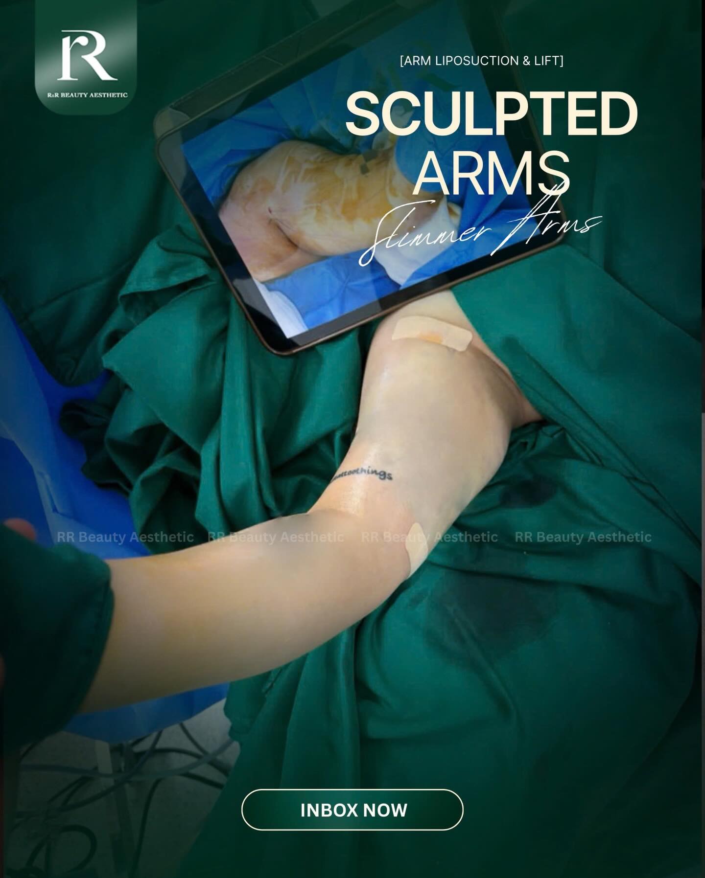 ✨ **SCULPTED ARMS
✨ Removes Stubborn Arm Fat
✨ Tightens Loose Skin
✨ Creates Leaner Arm Contours
✨ Improves Upper Arm Definition
✨ Enhances Overall Body Balance
✨ Natural, Long-Lasting Results
📞 **Hotline: +84 777 777 787**
.
.
.
#armliposuction #armlift #bodycontouring #slimmerarms #rrbeautyaesthetics
arm liposuction arm lift upper arm contouring slimmer arms body sculpting skin tightening body transformation aesthetic surgery natural body contour confidence