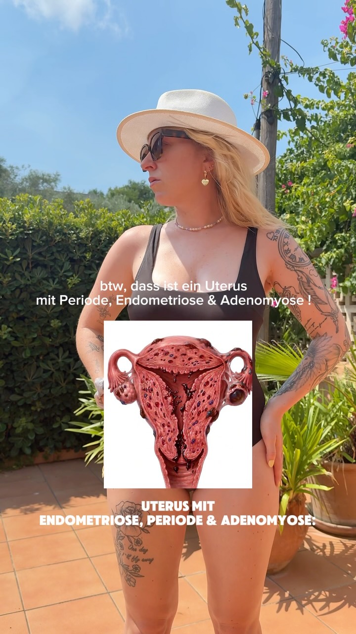 Endometriose ist mehr als starke Periodenschmerzen. 💛
Bei Endometriose wächst Gewebe, das der Gebärmutterschleimhaut ähnelt, außerhalb der Gebärmutter. Das kann Entzündungen, Verwachsungen und starke Schmerzen verursachen und Organe schädigen!
Für Betroffene bedeutet das oft:
• Schmerzen nicht nur während der Periode, sondern auch an vielen anderen Tagen.
• Erschöpfung, die den Alltag und die Arbeit beeinträchtigen kann.
• Schmerzen beim Sport, beim Toilettengang oder beim Sex.
• Häufig jahrelanges Warten auf eine Diagnose.
• Einen oft unsichtbaren Kampf, den Außenstehende nicht sehen.
• und vieles mehr!
Endometriose ist eine chronische und unheilbarere Erkrankung keine “normale Regelschmerzen”, die man einfach aushalten muss.
Lasst uns darüber sprechen, aufklären und Betroffenen zuhören. Mehr Wissen bedeutet mehr Verständnis und hoffentlich eine schnellere Diagnose und bessere Unterstützung. 💛
#endometriose #periode #uterus #aufklärung #endometriosekämpferinnen