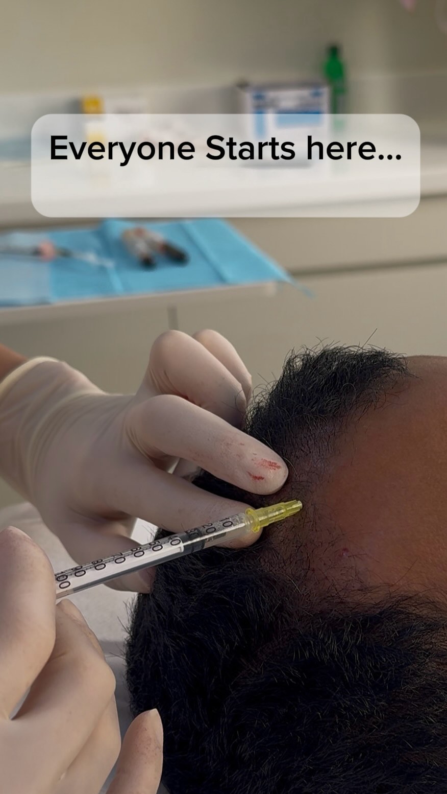 The biggest mistake in hair loss treatment isn’t choosing the wrong PRP, exosome, or medication.
It’s choosing a treatment before knowing what you’re treating.
Hair loss isn’t a single diagnosis.
Two people can have the same complaint—“I’m losing my hair”—but need completely different treatment plans.
One may have androgenetic hair loss.
Another may have a nutritional deficiency.
Another may have an inflammatory or scarring condition.
The treatment isn’t determined by the symptom.
It’s determined by the diagnosis.
That’s why I don’t start by asking, “Which treatment should we do?”
I start by asking, “Why is this patient losing hair?”
Because the right treatment for the wrong diagnosis is still the wrong treatment.
Every successful hair restoration journey starts with one thing:
The right diagnosis✅
.
.
.
#hairloss #hairlosstreatment #exosome #prp