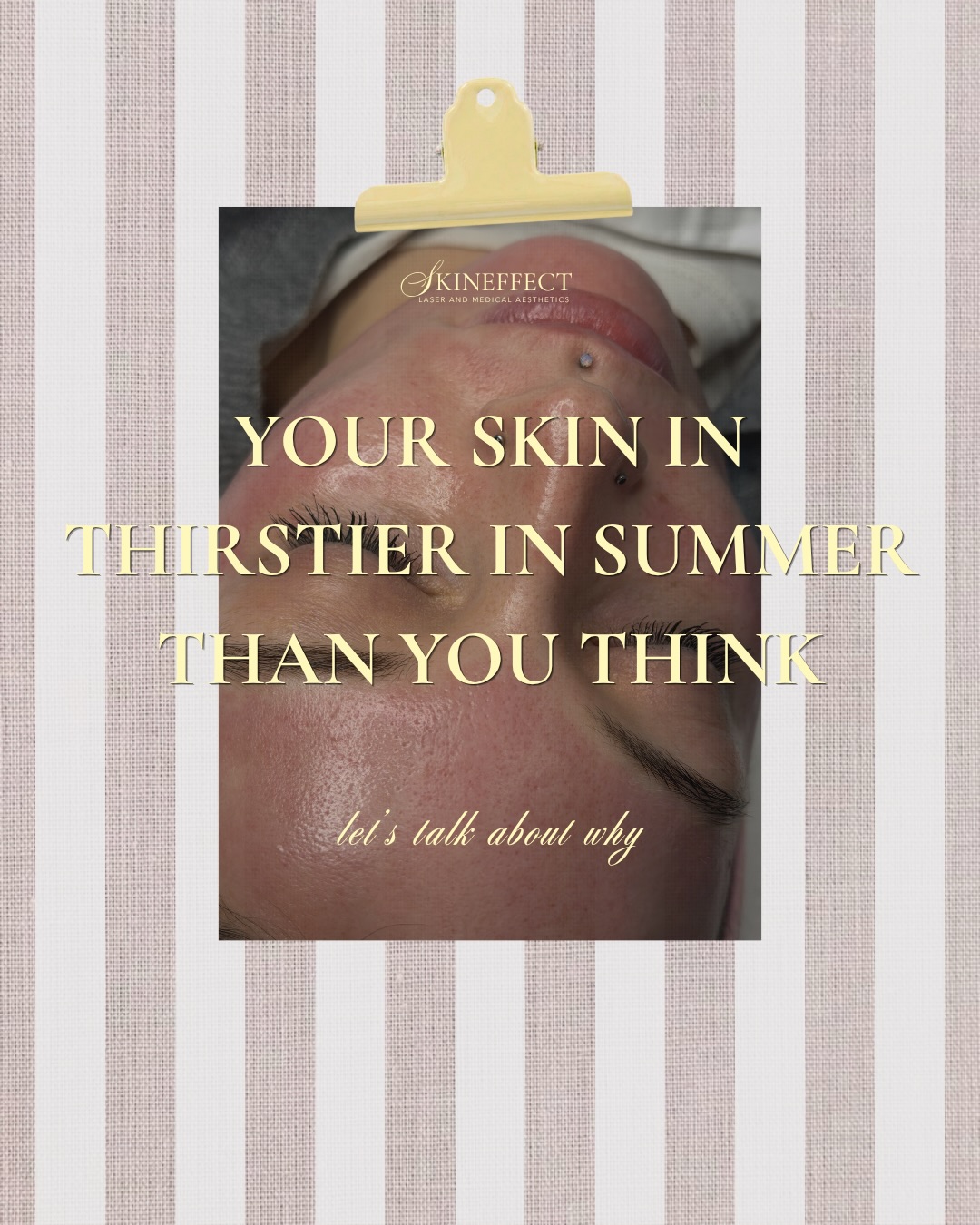 Your skin is thirstier in summer than you think. ☀️💦
Heat, sun exposure, and AC don’t just make you sweat — they pull moisture from your skin faster than you can drink it back. The result? Dullness, excess oil (your skin overcompensating for the loss), and a weakened moisture barrier that makes fine lines more visible.
Our go-to hydration fix:
✨ SkinCeuticals B5 Gel — lightweight hyaluronic acid gel that plumps and locks in moisture
✨ Alumier Ultimate Boost Serum — barrier-strengthening hydration for all skin types
✨ A Hydrafacial to deeply replenish what summer strips away
Glass skin isn’t luck. It’s hydration done right.
Book your Hydrafacial today — link in bio ✨
#SkinEffect #Hydrafacial #SkinHydration #SummerSkincare #SkinBarrier