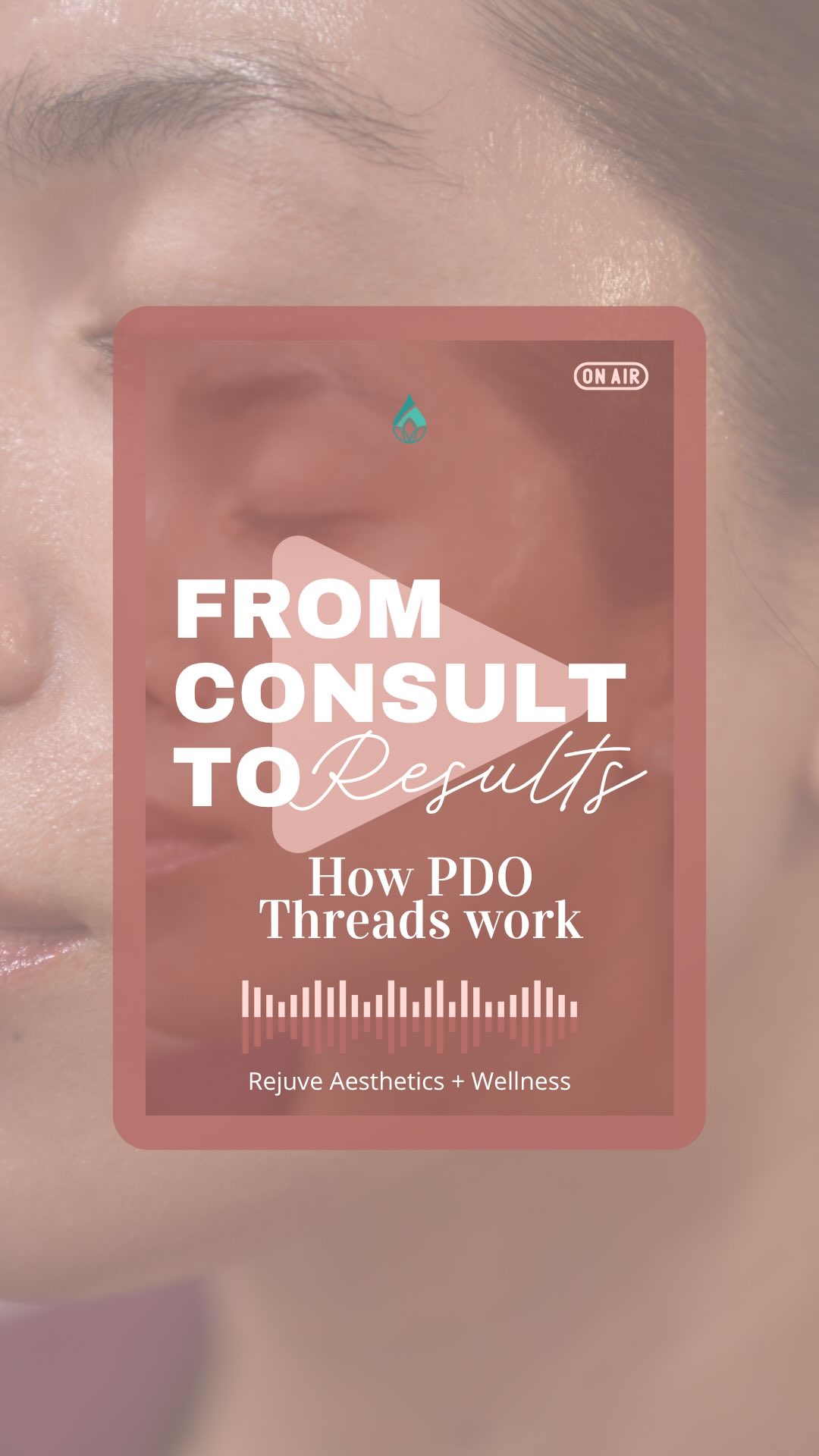 This is what a non-surgical face lift looks like at Rejuvé. ✨
PDO thread face lifting works by placing dissolvable threads under the skin to physically lift sagging tissue — while also triggering your body’s natural collagen response. Two mechanisms, one treatment.
Who it’s great for:
→ Anyone noticing jowl softening or heavy smile lines
→ People who want a lifted look without surgery
→ Clients who’ve tried fillers but want more structural lift
Downtime is minimal. Most clients are back to their normal routine within a few days.
Watch the full consult-to-result in this video — and DM us if you want to know if you’re a candidate. 💛
#pdothreads #threadlift #facelift #nonsurgicalfacelift #medspahawaii honoluluskincare rejuveaesthetics collagenstimulation hawaiiskincare liftandtighten