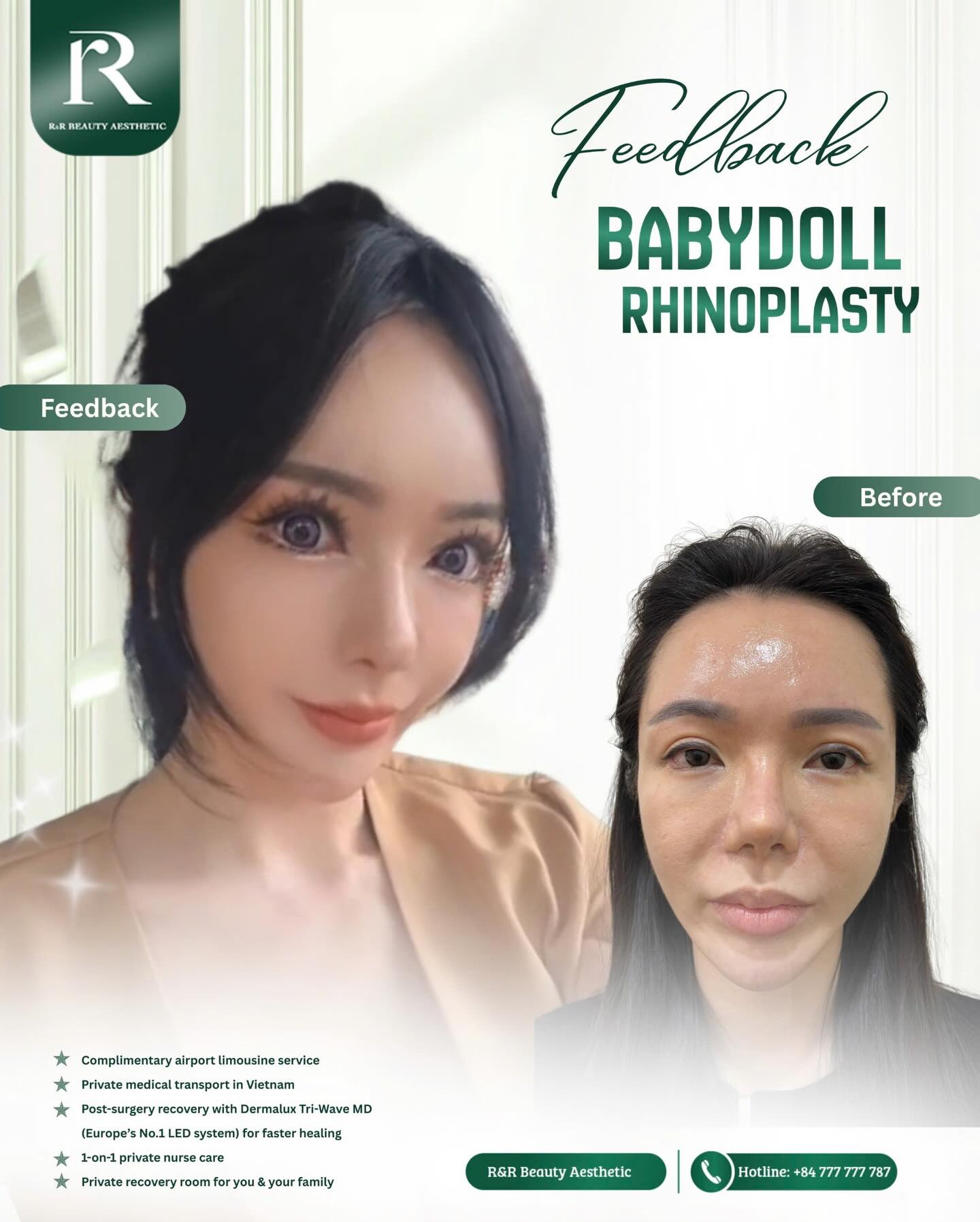 ✨ #Feedback - **BABY DOLL RHINOPLASTY** ✨
Baby Doll Rhinoplasty is designed to create soft, refined, and naturally balanced nasal contours that enhance your facial harmony while preserving your unique beauty. The result is a delicate profile that looks elegant from every angle.
✨ Refined Nose Bridge
✨ Soft, Natural Tip
✨ Balanced Facial Proportions
✨ Improved Side Profile
✨ Elegant, Feminine Contours
✨ Natural-Looking Results
✈️ **International patients are welcome**
✔ Complimentary airport pick-up
✔ Private medical transportation
✔ Post-surgery recovery with Dermalux Tri-Wave MD
✔ Plus LED therapy for faster healing
✔ 1-on-1 private nurse care
✔ Private recovery room for you and your family
📞 **Hotline: +84 777 777 787**
.
.
.
#babydollrhinoplasty #rhinoplasty #nosejob #facialharmony rrbeautyaesthetics
baby doll rhinoplasty natural nose surgery nose refinement facial harmony nose reshaping cosmetic surgery beauty transformation international patients Vietnam plastic surgery
