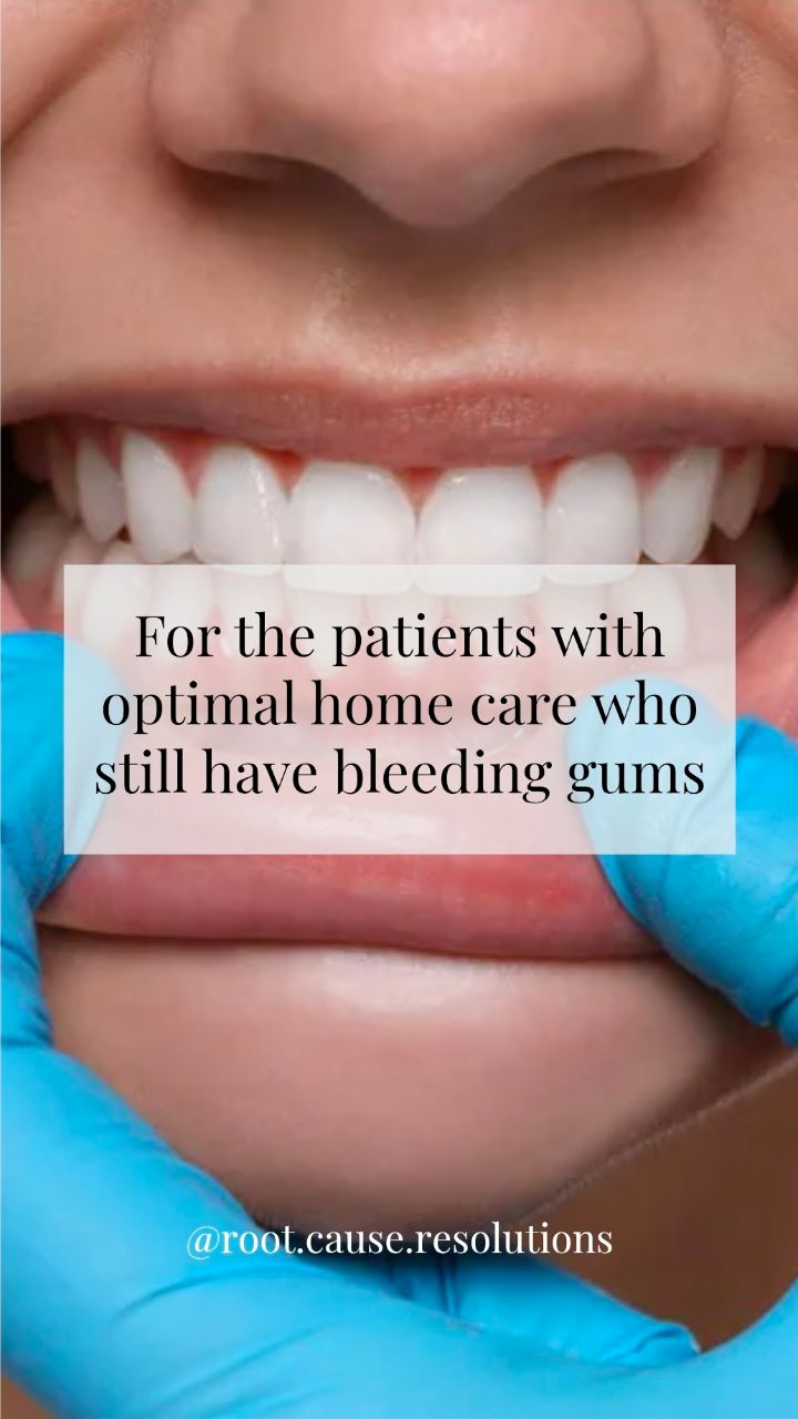 For the patients who have excellent home care and still have bleeding gums, it's time to look beyond brushing and flossing.
Bleeding is a sign that something isn't functioning optimally. When plaque levels are low and home care is consistent, consider factors that may be contributing to inflammation beneath the surface:
➡️ Mouth breathing
➡️ Dry mouth (xerostomia)
➡️ Snoring and sleep-disordered breathing
➡️ Acid reflux (GERD/LPR)
➡️ Crowded teeth and plaque-retentive anatomy
These factors can alter the oral environment, reduce the protective benefits of saliva, increase tissue inflammation, and create conditions that support dysbiosis.
#sleep #wholebodyhealth #oralhealthcare #prevention #dentistry