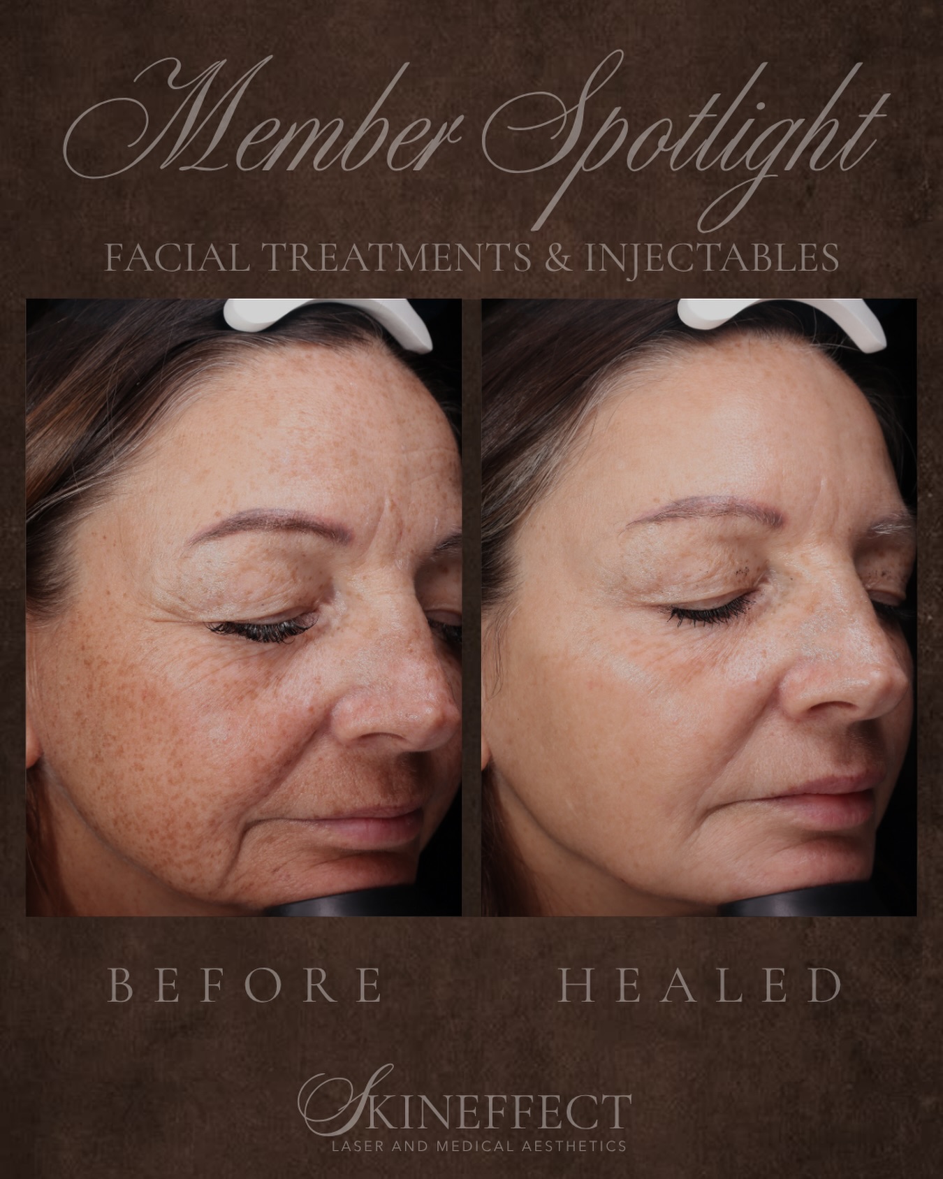 Results like this aren’t an accident — they’re a strategy. ✨
At SkinEffect, we don’t believe in one-and-done treatments. Real transformation happens when injectables and facials work together, guided by a plan built specifically for your skin.
This member’s results reflect months of intentional care: strategic filler placement by our injectors, paired with facials that support skin health, hydration, and longevity between appointments. It’s not about doing more — it’s about doing what’s right, in the right order, at the right time.
That’s the difference a membership with SkinEffect makes: a team that sees the full picture, not just the next appointment.
Ready to build your plan? Link in bio to book your consultation. 🤍
#SkinEffect #HolisticAesthetics #MemberResults #BeforeAndAfter #medicalaesthetics