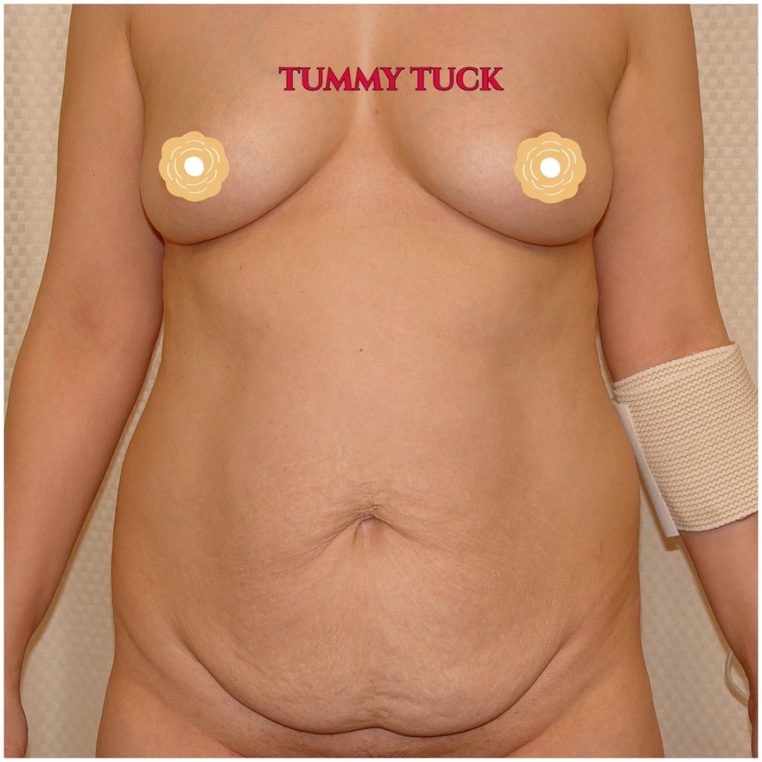 After 3 kids and a c-section, this soccer mom decided she wanted her tummy as flat as it did when she was 21. I did a tummy tuck, rectus muscle tightening with sutures, and liposuction of her love handles. She now loves her flat tummy and thin waistline.