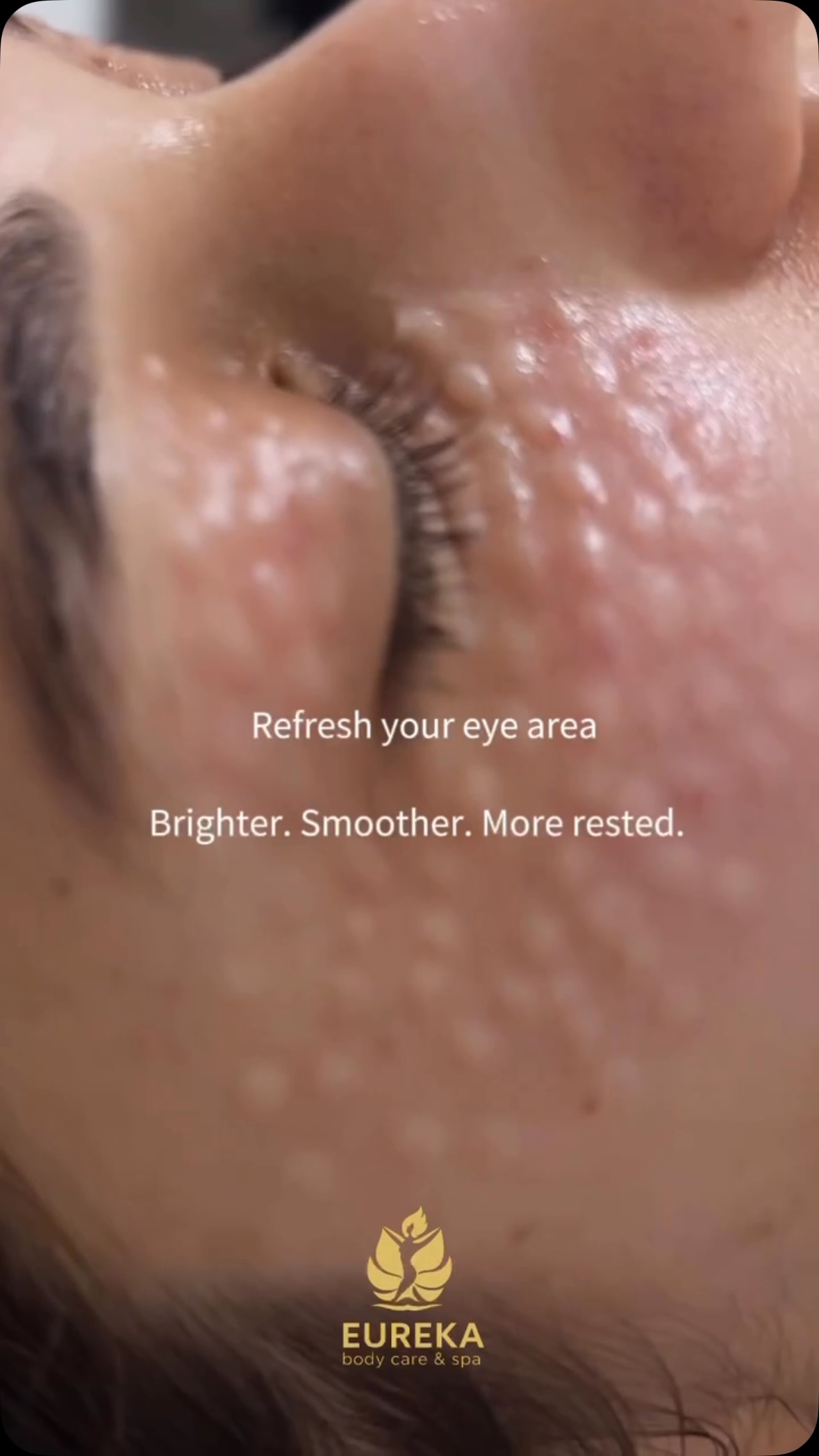 ✨ Bright, refreshed eyes can make your whole face look younger and more energized.
The delicate skin around the eyes is often the first area to show signs of aging, fatigue, puffiness, and fine lines. With personalized injectable treatments and advanced aesthetic techniques, we can help improve the appearance of the under-eye area, reduce the look of bags and puffiness, soften age-related changes, and enhance overall skin quality for a naturally refreshed look.
Every treatment plan is customized to your unique facial anatomy and aesthetic goals.
📍 Eureka Body Care & Spa
37 E 28th Street, Floor 7, Suite 700
New York, NY 10016
📞 (212) 858-0706
📱 Text: (833) 255-9387
#UnderEyeRejuvenation #NaturalResults #NYCAesthetics