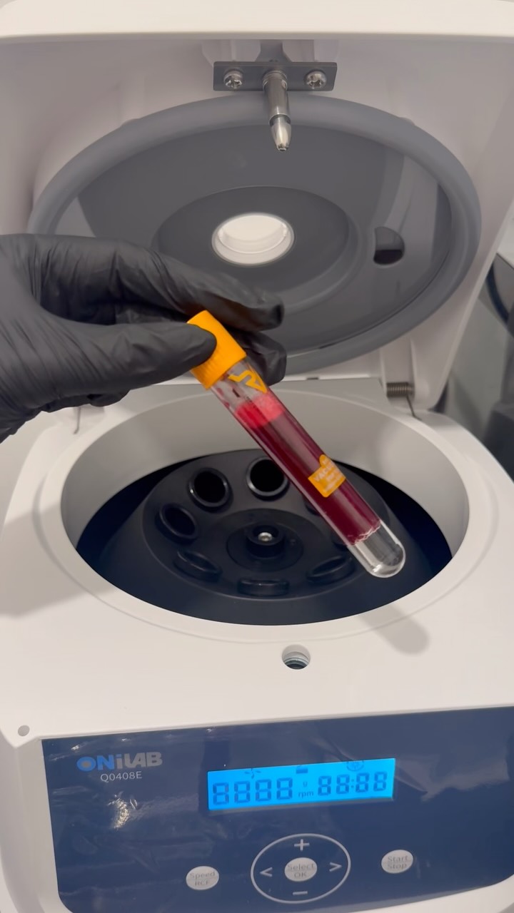 Let’s talk about one of my favourite machines… the centrifuge.
This is where the magic begins for your PRP treatment. After taking a small blood sample using specialised vacutainer tubes, they’re carefully placed into the centrifuge, where they spin at a precise speed to separate the different components of your blood.
The result? A concentrated layer of platelet-rich plasma (PRP) – packed with growth factors that can help stimulate collagen production, support tissue repair and encourage natural rejuvenation.
Because PRP is created using your own blood, it’s a completely natural treatment that’s loved for improving skin quality, supporting hair restoration and enhancing healing.
It’s a simple step in the process, but one of the most important—and it’s fascinating to watch! 🩸✨
Have you ever wondered how PRP is made? Let me know your questions below.
Book online at www.bgaesthetics.co.uk 🌸
Pay in 3 with Klarna 🌸
#PRP #PlateletRichPlasma #AestheticClinic #SkinRejuvenation #HairRestoration
