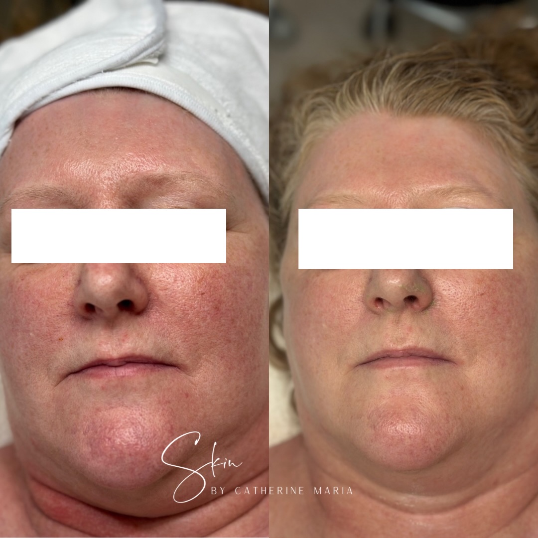 Never underestimate the power of Dermaviduals 🤍
These results are more than just a before and after - it’s a reflection of what can happen when we stop fighting and guessing the skin and start supporting it.
These photos were taken during a new client’s very first bespoke treatment (we haven’t even started on Dermalux LED light therapy!)
If you’re new to Corneotherapy, it’s also important to know that your skin may go through a short adjustment period. As your skin barrier begins to repair, some people experience temporary dryness, flaking or congestion, while others notice very little adjustment. Every skin responds differently, and I will guide you through the process, adapting your homecare and treatments as your skin changes.
If you’re ready to start your skincare journey, book via the link in my bio or send me a message.
📍 Aylesbury, Buckinghamshire
📩 info@skinbycatherinemaria.com
#aylesbury #aylesburyvale #aylesburybusiness #aylesburyfacial #dermaviduals