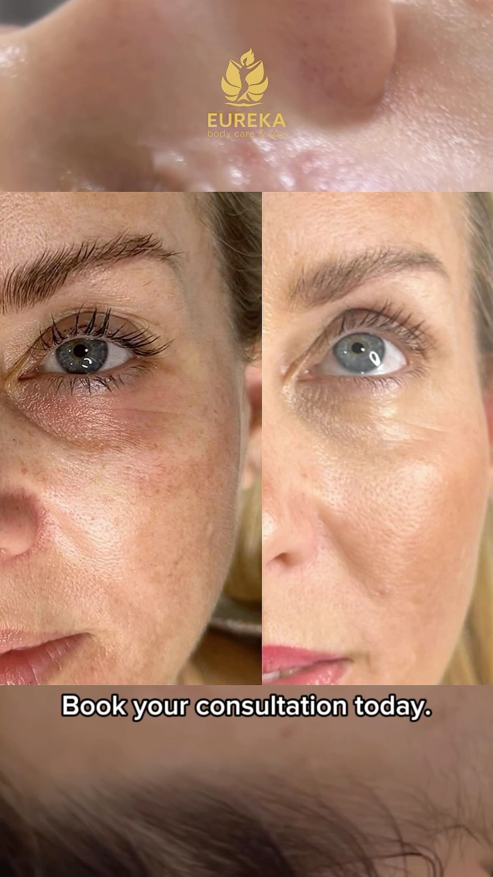 Your eyes say more than you think. ✨
If under-eye bags, puffiness, or dark circles make you look tired, a personalized treatment plan can help restore a fresher, brighter appearance. Every under-eye area is unique, which is why we choose the best approach based on your individual needs.
Ready to refresh your look? Schedule your consultation today.
📍 Eureka Body Care & Spa
37 E 28th St, Floor 7, Suite 700
New York, NY 10016
📞 (212) 858-0706
💬 Text: (833) 255-9387
#UnderEyeCare #DarkCircles #EyeRejuvenation #FreshLook #NYCMedSpa EurekaBodyCare