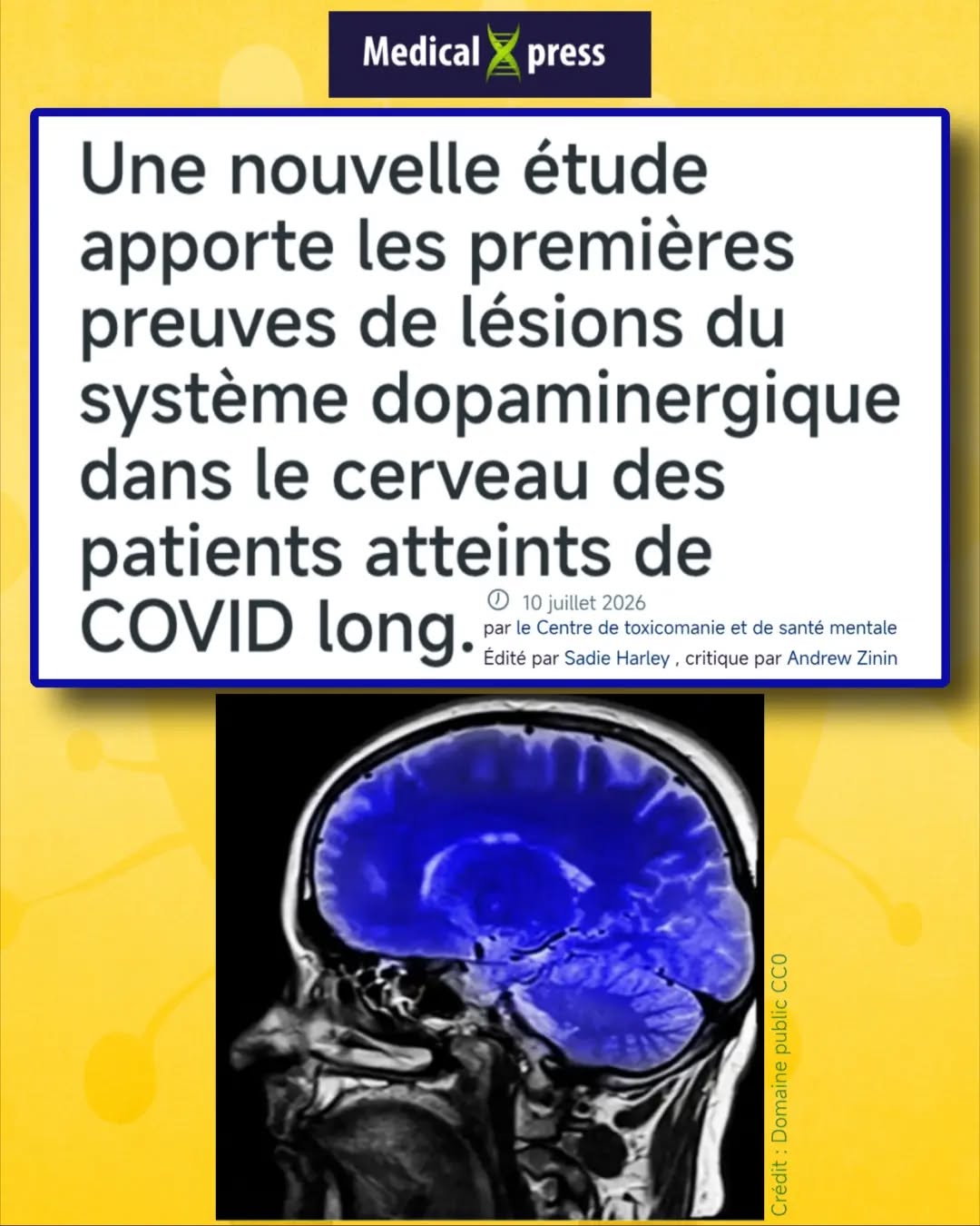 🧵🔬Une nouvelle étude publiée dans eBioMedicine apporte une avancée majeure dans la compréhension du #CovidLong.
Grâce à une imagerie TEP, des chercheurs mettent en évidence, pour la première fois, une altération du système dopaminergique cérébral chez des personnes atteintes de #LongCovid
🧠Les chercheurs observent une diminution d'un marqueur des neurones dopaminergiques dans le striatum, une région essentielle pour :
- La motivation
- La mémoire
- Le mouvement
- Certaines fonctions cognitives
Plus cette diminution est importante, plus les symptômes sont marqués.
📊Les résultats montrent que :
• une atteinte du striatum ventral est associée à une perte de motivation ;
• une atteinte du putamen dorsal à un ralentissement des mouvements ;
• une atteinte du noyau caudé à des troubles de la mémoire.
Des corrélations qui apportent un support biologique à des symptômes décrits depuis des années par les patients.
🩺Le Dr Jeffrey Meyer, auteur principal de l'étude, déclare :
« Nos résultats apportent la preuve convaincante que le #CovidLong implique la perte de neurones libérant de la dopamine. »
L'équipe s'appuie sur ses travaux précédents montrant une inflammation persistante dans ces mêmes régions du cerveau chez les personnes atteintes de #CovidLong.
🧬Comme l'explique le Dr Jeffrey Meyer :
🗣️« Nous savons que l'inflammation peut endommager les neurones dopaminergiques (...) cette étude apporte la preuve directe que le marqueur des neurones dopaminergiques est réduit dans ces mêmes régions, et que cette perte est corrélée aux symptômes des patients. »
💊Cette découverte ouvre également de nouvelles perspectives thérapeutiques.
Le Dr Jeffrey Meyer souligne :
« Ces résultats indiquent que le #CovidLong est, au moins en partie, un dysfonctionnement du système dopaminergique cérébral. »
👉Un essai clinique ciblant la fonction dopaminergique devrait prochainement être lancé afin d'évaluer son effet sur la fatigue, les troubles cognitifs et la motivation.
📝Dans un commentaire publié dans The Lancet, le Dr Éric Guedj et Danielle Beckman replacent ces résultats dans un contexte plus large :
⏬Suite en commentaire ⏬