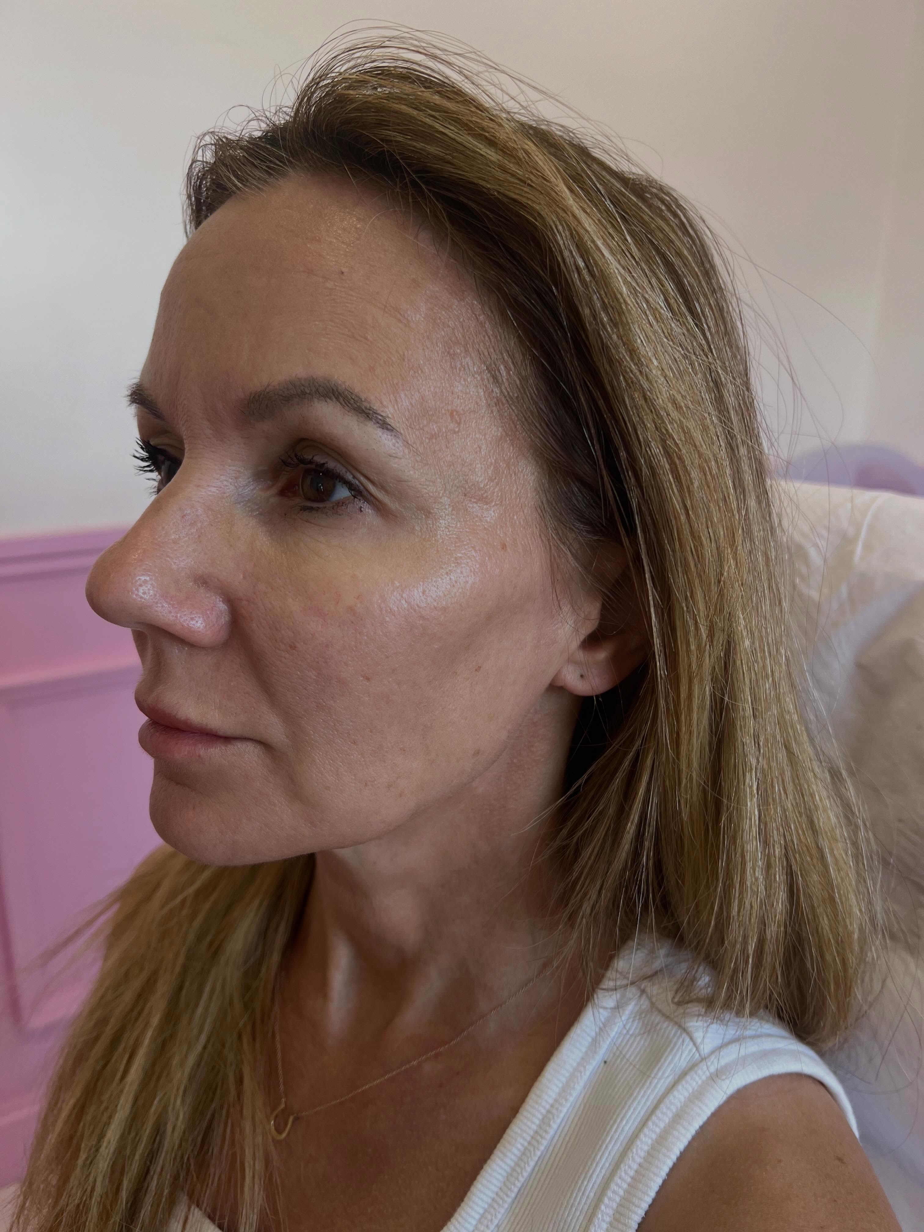 Face harmonisation using HA filler for natural results, leaving you feeling refreshed and confident
Comment “refreshed” for more information
R x