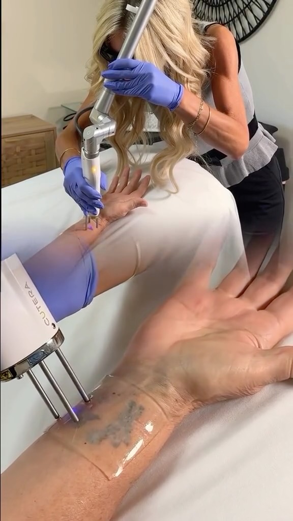 Smarter tattoo removal starts here. 🔬
With the DESCRIBE® PFD Patch, we’re able to perform up to 4 laser passes in a single treatment instead of just 1. The patch reduces the temporary whitening (“frosting”) that occurs after each laser pass, allowing additional passes to be performed safely during the same appointment.
Benefits:
🔹 Up to 4 laser passes in one treatment
🔹 More efficient treatment sessions
🔹 May enhance tattoo clearance, particularly for stubborn or resistant ink
🔹 Added epidermal cooling for increased comfort and skin protection
🔹 May reduce the total number of treatments needed
Every tattoo has its own removal journey. The DESCRIBE® PFD Patch helps us make each treatment as efficient, comfortable, and effective as possible.
#TattooRemoval #PicoLaser #DescribePFDPatch #LaserTreatment