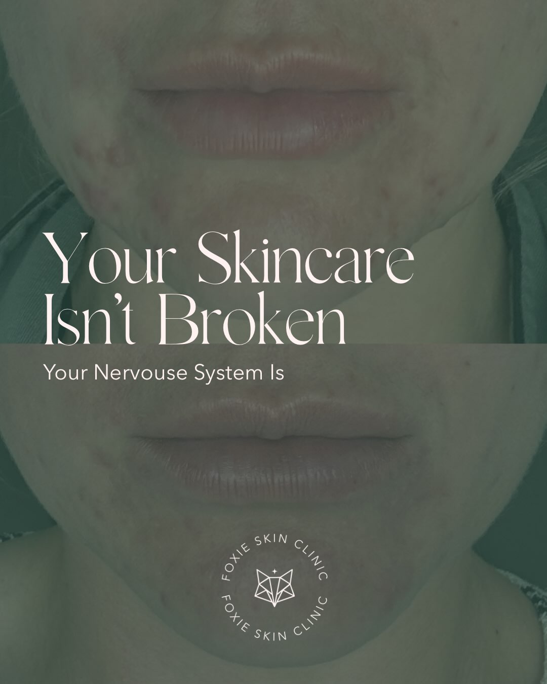 Your skincare isn’t broken. Your nervous system is 😥
This client came to us having tried it all: the serums, the supplements, the dermatologist appointments, the lot. Nobody had looked at what was actually running the show, which in her case was two small boys she affectionately calls “feral” and a cortisol level that never got the memo to switch off 🙅🏼♀️
So alongside her supplement stack and food changes, we rebuilt her nervous system regulation to fit her actual life, not a fantasy version where she has ninety minutes a day for a bath and a candle. Something that survives the school run 💪🏼
This is 6 weeks in. Halfway through the programme 👀 She’s not even finished cooking.
If you’ve bought every product on the shelf, sat through every doctor’s appointment, and you’re still cancelling plans because you can’t face your skin under lights, the problem was never your routine 😬
DM the word “BLUEPRINT” and let’s find what actually is and clear your acne for good 🫶🏼✨