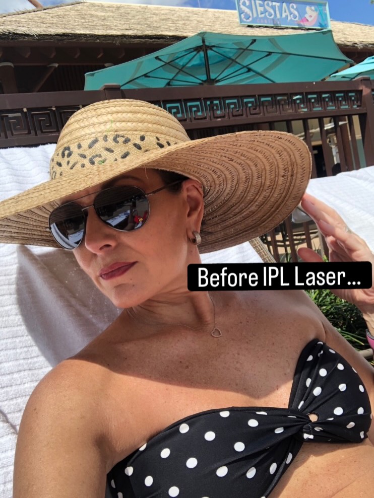 It’s amazing to look at photos before I started really taking my skincare seriously. It’s not that I didn’t have a skincare routine…it was just always minimal. And, like most working moms…certain things just don’t become a priority when you’re raising children, grocery shopping, appointments…etc.
Looking at the miraculous outcome of my journey with the @theskingroup is quite amazing. From treatments for my Versi-Color skin condition to sun damage treatment and more… it has been a wonderful friendship:)
You can book a free consult for skincare…that should be a no brainer for everyone:) What’s one area you’ve been putting off in your skincare journey?
#skincare #theskingroup #ipllaser #familyowned