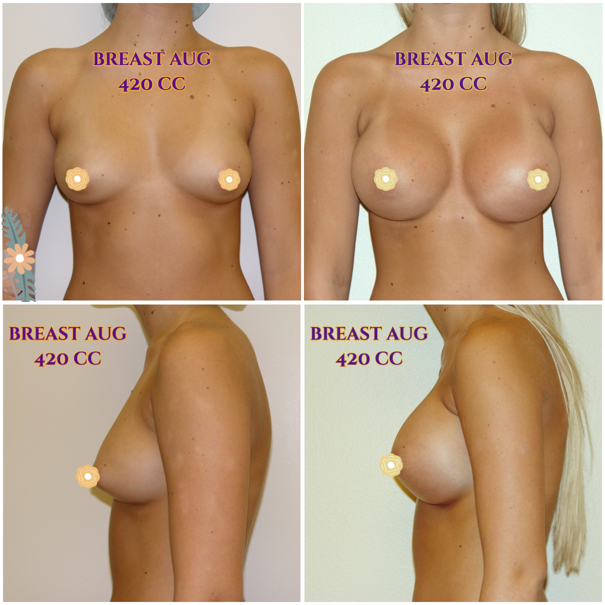 Call now for our Mid-Summer Specials! Saline Breast Aug -->$3995 Silicone Breast Aug --> $6495 Tummy Tuck starts at --> $7995. Call (714) 500-0050 #drluudoan #breastaug #salineimplants #siliconegelimplants #tummytuck #abdominoplasty