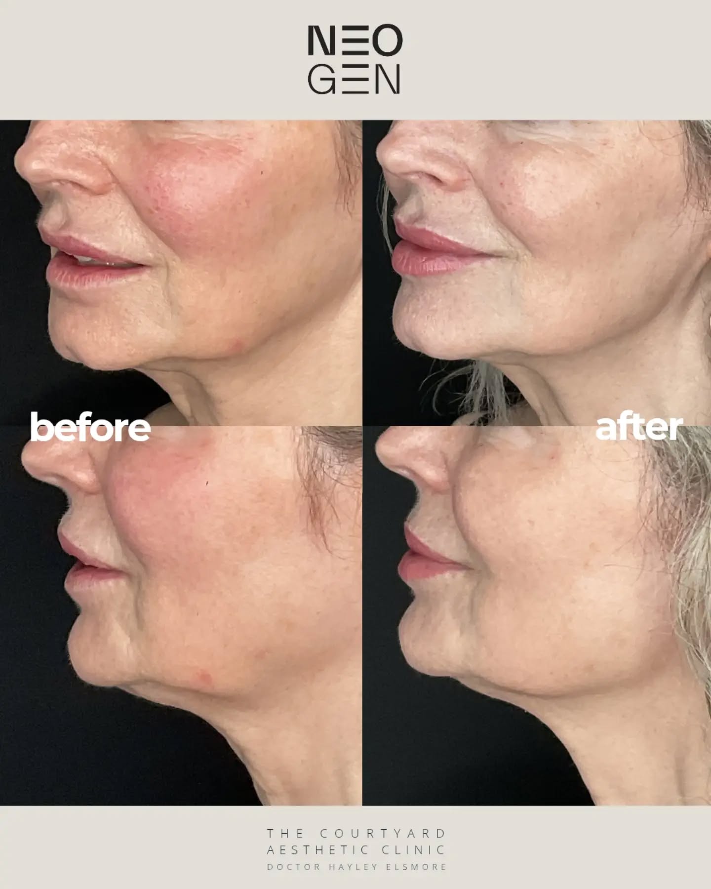 ✨ Check out these before & after results following NeoGen treatment!
Notice the visible improvements in skin texture, tone, and firmness, especially around the lower face and jawline.
NeoGen is the perfect treatment to refresh your skin after summer, targeting pigmentation, fine lines, and loss of firmness caused by UV exposure. It helps restore clarity, tighten laxity, even out skin tone, and stimulate collagen production for long-lasting skin renewal.
Ready to bring back your post-summer glow? Book your NeoGen consultation or treatment and let your skin recover, renew, and glow this autumn 🍂
#neogen #neogenplasma #skinrenewal #skintreatment #skintightening