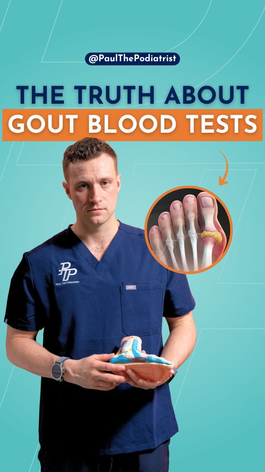 Red, hot, swollen big toe joint. You’re pretty sure it’s gout. 🔴
Then the blood test comes back normal and you’re told it isn’t.
Here’s the bit most people miss: during an active attack, the uric acid has moved into the joint. Up to 30 to 50% of people with active gout have normal or low blood levels at the time of testing.
Normal bloods do not rule it out.
What does help? An ultrasound of the joint. If we see the double contour sign, that points to urate sitting in the joint, and you can go back to your doctor with something concrete to work from and get the right medication to settle the attack and reduce the chance of it coming back.
Found this useful? Let me know in the comments 👇
Follow for more foot health tips 👣