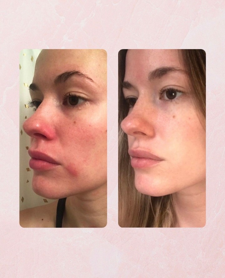 Seeing redness, dehydration or irritation in your clients 💙✨
These are key indicators of a compromised skin barrier and should be addressed early within your treatment plan
Barrier Fix Daily Hydrator is designed to deliver targeted hydration while supporting barrier repair and overall skin resilience
Formulated with silver ear mushroom, plant glucosides and beta glucan, it helps calm visible irritation and restore balance to stressed skin 🙌
An essential in both treatment protocols and home care recommendations for sensitive or reactive clients
Because a strong barrier is the foundation of healthy skin
#salonconnectau #salonconnect #professionalskincare #skintherapist #estheticianlife #treatmentroom #skinbarrier #sensitiveskin #hydration #resultsdriven #skincareprofessionals #cliniccare #aesthetics #beautybusiness
