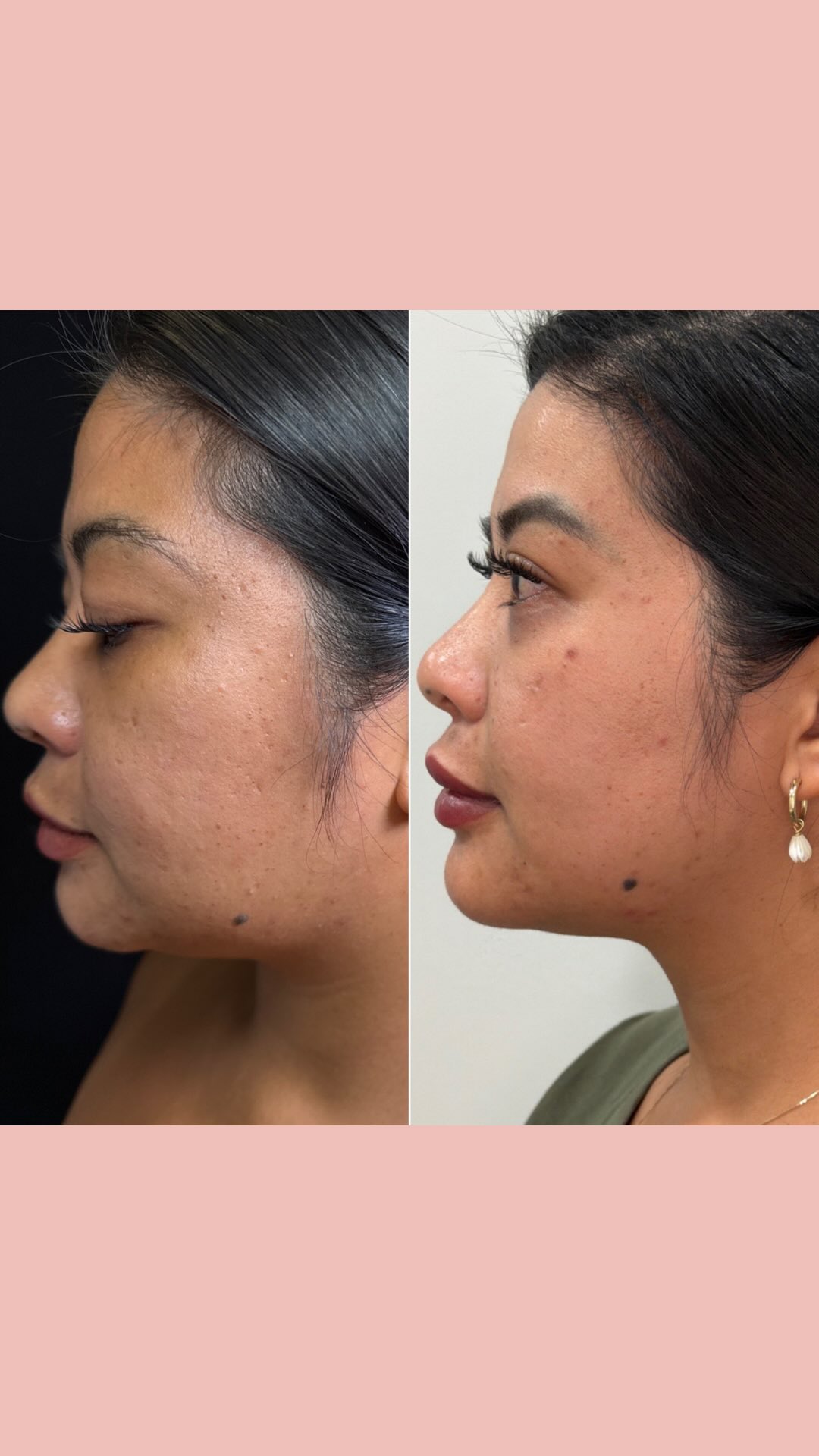 POV: it’s after photo time and we are NOT playing around 🎬📸
When your client’s results are so good you have to go full Gail Hailstorm to document the moment. Get the camera ready!
Results like these deserve the full production. ✨
📲 Book your transformation at the link in bio.