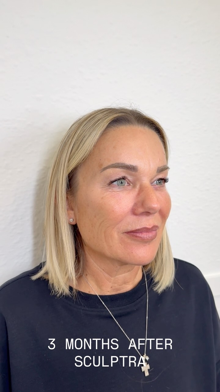 3 MONTHS AFTER SCULPTRA