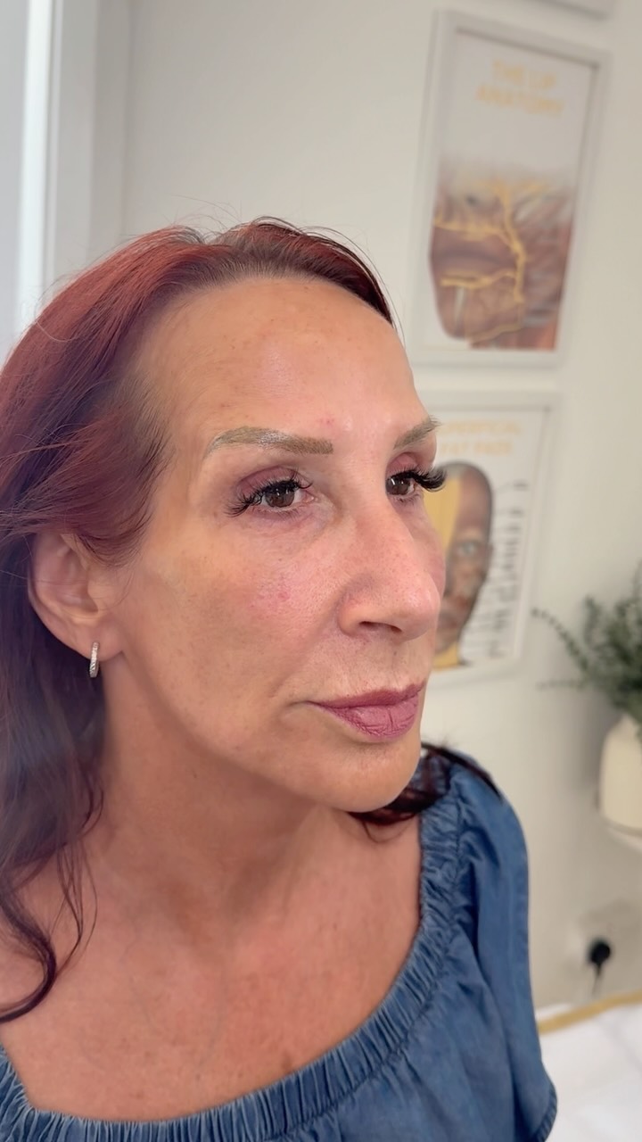 Tweakments are what we’re good at 🤍
Barely noticeable, but noticeably fresher.
A subtle dermal filler transformation designed to enhance what’s already there — restoring balance, softening shadows and giving the face a beautifully refreshed appearance without looking “done”.
✨ Natural-looking results
✨ Subtle enhancement
✨ Confidence, without changing your features
Book online at www.bgaesthetics.co.uk
Pay in 3 with Klarna 🌸
#DermalFiller #facialfiller #fillertransformation #antiaging #aesthetics