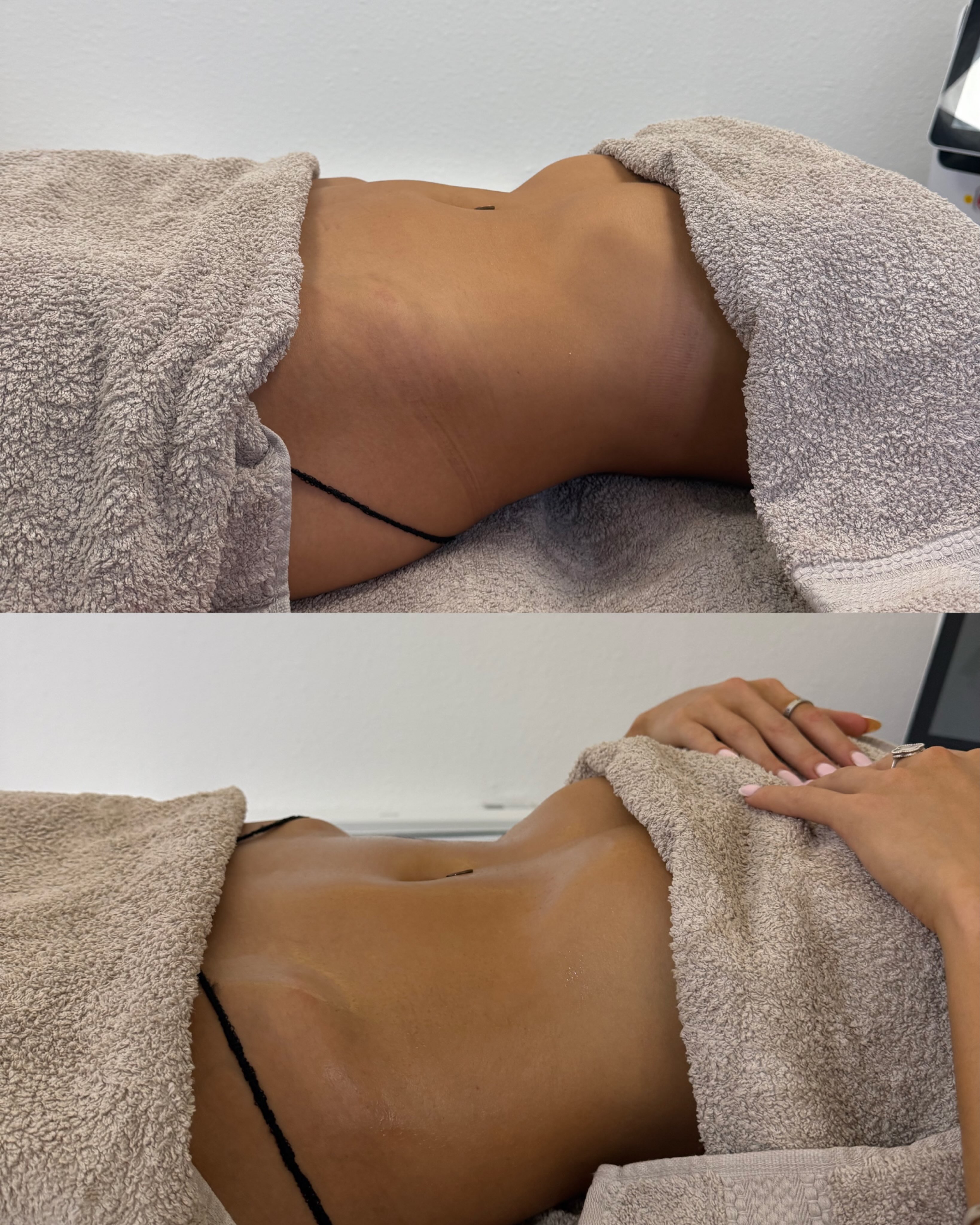 ✨ The difference manual lymphatic drainage can make
This before & after shows the immediate effect of manual lymphatic drainage (MLD) on the abdomen.
The after isn’t simply about looking “smaller” — we’re looking at reduced fluid retention and puffiness, creating a smoother, less congested appearance through the abdomen. 🤍
MLD uses gentle, rhythmic techniques to encourage the movement of lymphatic fluid, helping the body naturally process excess fluid and reduce that heavy, bloated feeling.
It can be particularly lovely when you’re feeling puffy, bloated or retaining fluid, or simply want to feel lighter and more comfortable in your body.
Book online at www.bgaesthetics.co.uk
Pay in 3 with Klarna 🌸
#ManualLymphaticDrainage #LymphaticMassage #massage #bloating #lymphaticdrainagemassage