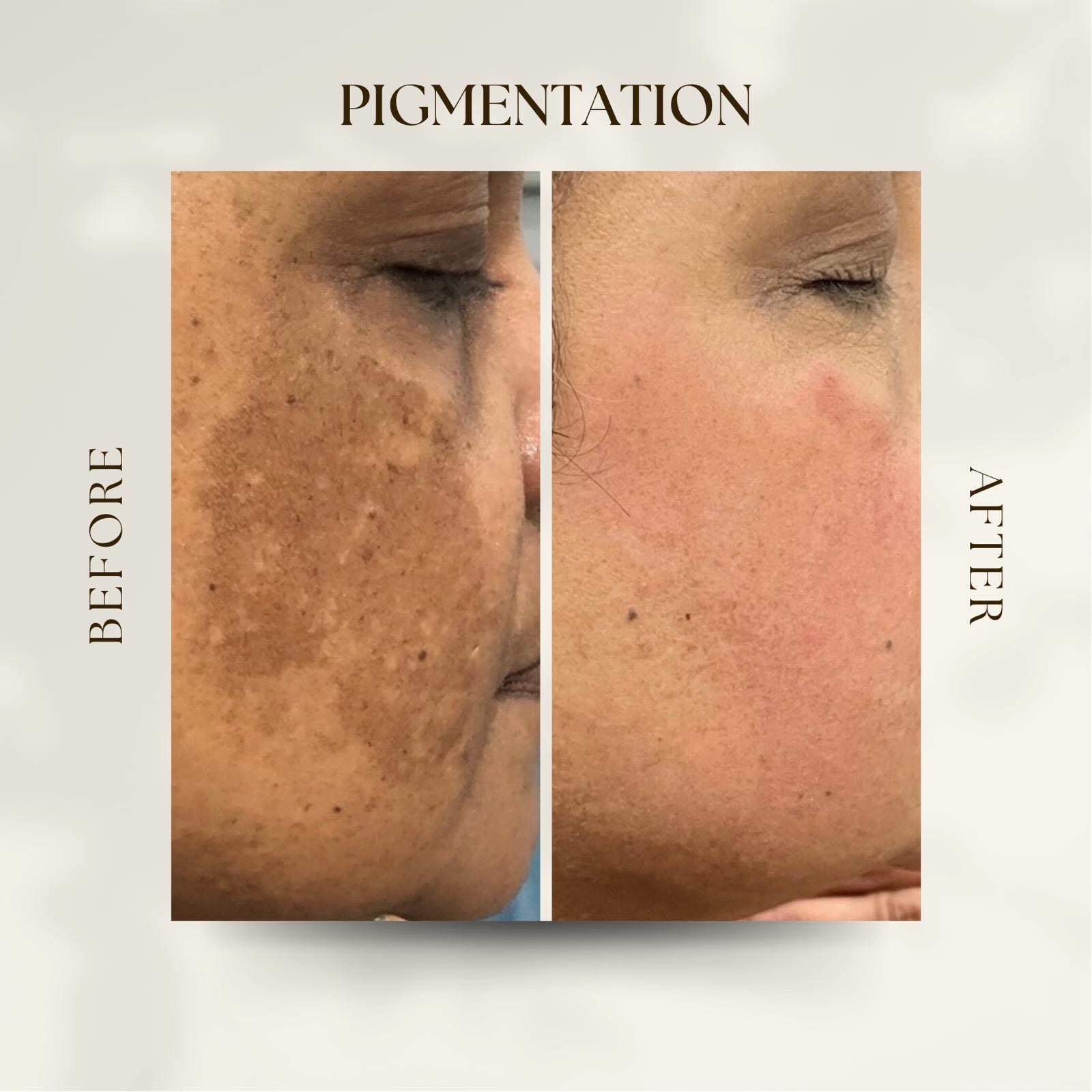 Pigmentation. It doesn’t arrive gradually. It arrives all at once, usually the second summer, usually across the cheekbones. Collagen. UV breaks it down faster than your skin rebuilds it. That’s the softening along the jaw you can’t quite name.
Texture. Sun, salt and dehydration thicken the surface. Makeup stops sitting right.
None of this is vanity. It’s photodamage, and it responds extremely well to being treated properly.
Save this one. Then DM me SKIN and we’ll look at where yours actually is.