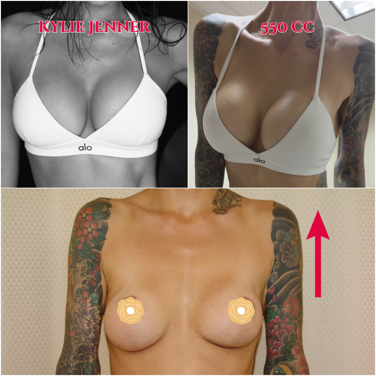 This patient really really wanted Kylie's breasts. I think we did a pretty good job of satisfying her wishes. Call now for our Mid-Summer Specials! Saline Breast Aug -->$3995 Silicone Breast Aug --> $6495 Tummy Tuck starts at --> $7995. Call (714) 500-0050 #drluudoan #breastaug #salineimplants #siliconegelimplants #tummytuck #abdominoplasty
