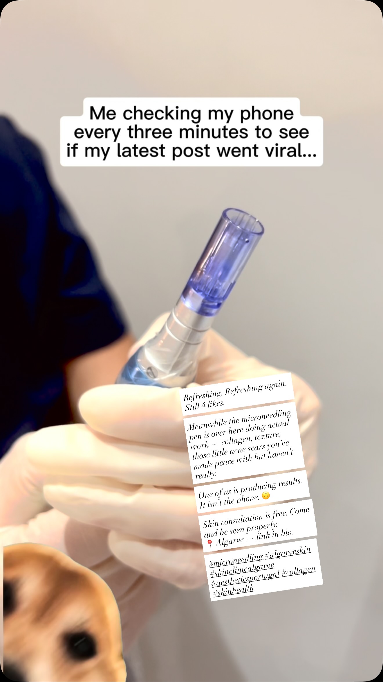 Refreshing. Refreshing again. Still 4 likes.
Meanwhile the microneedling pen is over here doing actual work, collagen, texture, those little acne scars you’ve made peace with but haven’t really.
One of us is producing results. It isn’t the phone. 🙃
Skin consultation is free. Come and be seen properly.
📍 Algarve — link in bio.
#microneedling #algarveskin #skinclinicalgarve #aestheticsportugal #collagen skinhealth