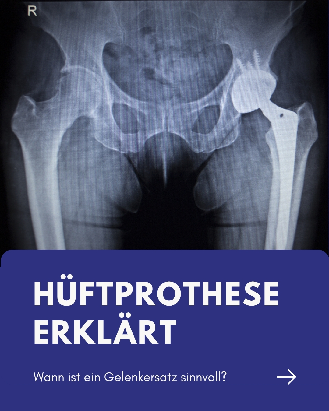 Wenn jeder Schritt schmerzt, kann eine Hüftprothese neue Bewegungsfreiheit ermöglichen.
Ist der Gelenkknorpel stark abgenutzt und bringen konservative Behandlungen keine ausreichende Linderung mehr, kann ein künstliches Hüftgelenk notwendig werden. Häufig steckt eine Hüftarthrose dahinter – aber auch Fehlstellungen, frühere Verletzungen oder andere Erkrankungen können die Ursache sein.
Dank moderner, minimalinvasiver Verfahren kann die Muskulatur weitgehend geschont und die Erholung beschleunigt werden. Eine computergestützte 3D-Planung hilft dabei, Größe und Position der Prothese individuell an die Anatomie anzupassen.
👉 In den Slides erfahren Sie, wann eine Hüftprothese sinnvoll ist, welche Beschwerden typisch sind und wie der Eingriff abläuft.