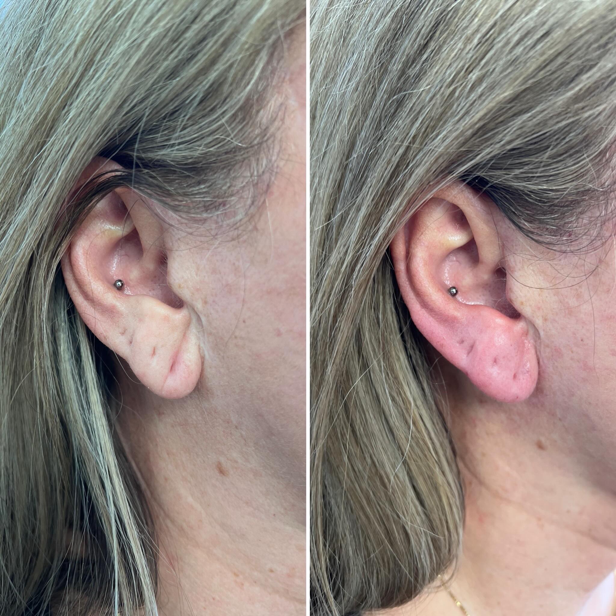 Earlobe restoration 🙌🏻🙌🏻
EARLOBE RESTORATION WITH DERMAL FILLER
It’s a small detail, but one that can make such a beautiful difference.
Over time, earlobes can lose volume, become elongated or appear thinner — particularly after years of wearing heavier earrings.
A carefully placed amount of dermal filler can help to:
• Restore lost volume
• Improve the shape and structure of the earlobe
• Support stretched or elongated piercing holes
• Help earrings sit more securely and beautifully
• Create a subtle, natural-looking rejuvenation
A quick treatment with minimal downtime — and often an area we don’t think about until we notice it!
A listers use this treatment to make sure every inch of their faces remain youthful!
Free consultations available!
COMMENT “yes” TO WIN A FREE TREATMENT
Winner chosen 10th September
R x