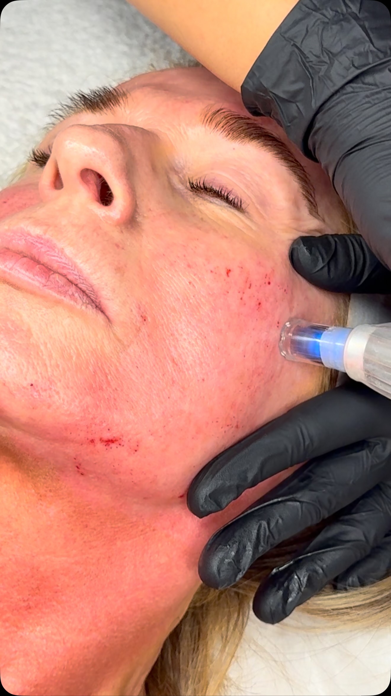 ✨ Microneedling Magic ✨
Ready for smoother, brighter, more radiant skin? Microneedling is a fantastic treatment to help improve the appearance of fine lines, acne scarring, uneven texture and enlarged pores — leaving your skin looking fresh, rejuvenated and glowing. ✨
Your skin, but better. 🤍
#Microneedling #dermapen #microneedlingfacial #facial #skincare
