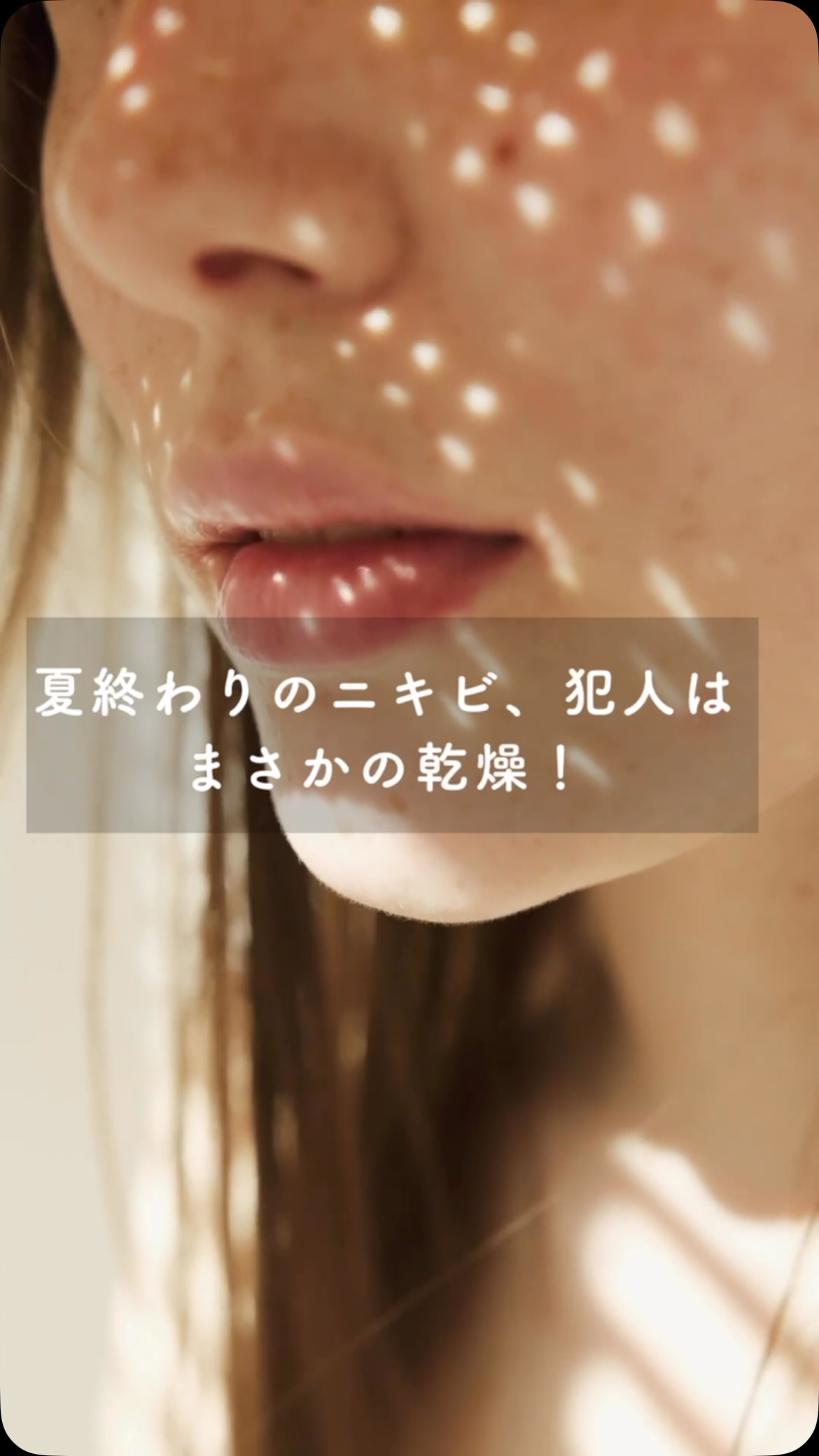 .
/
夏終わりのニキビ、犯人はまさかの乾燥!
\
.
8月後半~9月初旬にかけて急にニキビが増えるのは、汗や皮脂のせいだけではありません。
実はこの時期のニキビの多くは、肌の内部だけが乾燥する「インナードライ」が原因。
表面はテカっているのに、内部は水分不足というアンバランスな状態が続くことで、毛穴詰まりと炎症が一気に進みます。
.
【1】冷房で内部の水分が奪われる(インナードライの正体)
外は高温多湿、室内は冷房で乾燥。この温度差で肌の水分が蒸発しやすくなり、
内部が乾燥 → 皮脂が過剰分泌 → 毛穴が詰まる
という流れが起きます。
つまり、“皮脂が多いからニキビ”ではなく、“水分が足りないからニキビ”ができている季節。
【2】汗と皮脂が混ざり、毛穴をふさぐ
汗は皮脂・角質・メイクと混ざると毛穴を塞ぎやすく、アクネ菌が増えやすい環境になります。
さらに汗が長時間残ると角質がふやけ、バリア機能が低下し、炎症性ニキビが悪化します。
—
【3】紫外線で角質が固くなり、詰まりやすくなる
夏の紫外線は角質を厚くし、ターンオーバーを乱します。
古い角質が毛穴に蓄積し、詰まりニキビの原因に。
皮脂の酸化も進むため、赤みや炎症が起きやすくなります。
—
【3】夏の生活習慣の乱れも追い打ちに
睡眠不足や食事の乱れはホルモンバランスを崩し、皮脂分泌を増加させます。
これがインナードライと重なることで、ニキビが一気に悪化します。
最後に!
今の時期のニキビは、
インナードライ → 毛穴詰まり → ニキビ
という季節性トラブル。
水分補給・角質ケア・鎮静ケアを早めに取り入れることで、秋のゆらぎ肌を防ぎ、安定した肌に整います。
今ならこのクーポンがお得✨
_________________________
☀️平日限定【ツヤ肌管理】速攻美白毛穴除去小顔+首シワ/デコルテ40分29800円⇒
¥14,980
_________________________