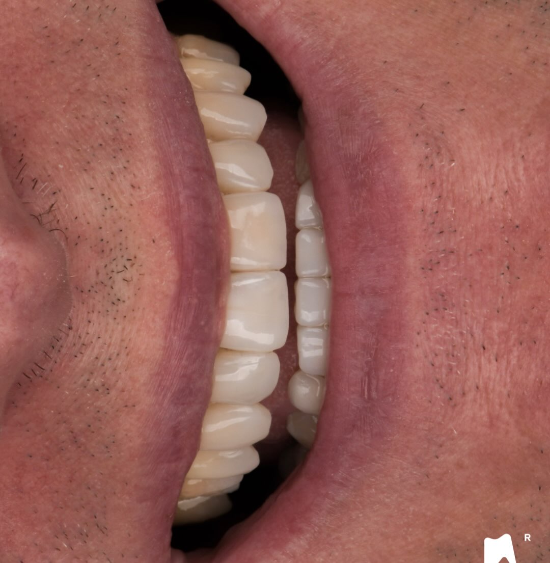 LAYERING & injection 14 to 24 and 33 to 43 : you want to learn about this technic ? Come link in bio
Additiv treatment !
ORTHO - RESTAU