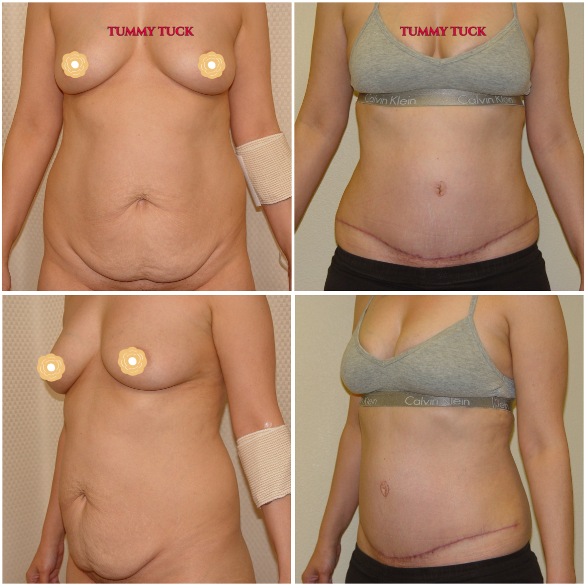 ABDOMINOPLASTY (Tummy Tuck) is the ultimate procedure to flatten your tummy. Tummy tuck removes loose/wrinkly skin, tightens flabby muscles, and includes lipo of the love handles and pubis. Tummy tuck results are dramatic and usually permanent. Call us now at 714-500-0050 for a consultation. #dr.luudoan #bellabeachbod #tummytuck #abdominoplasty #liposuction #liposculpture #bodycountouring #ocplasticsurgery #occosmeticsurgery #laplasticsurgery